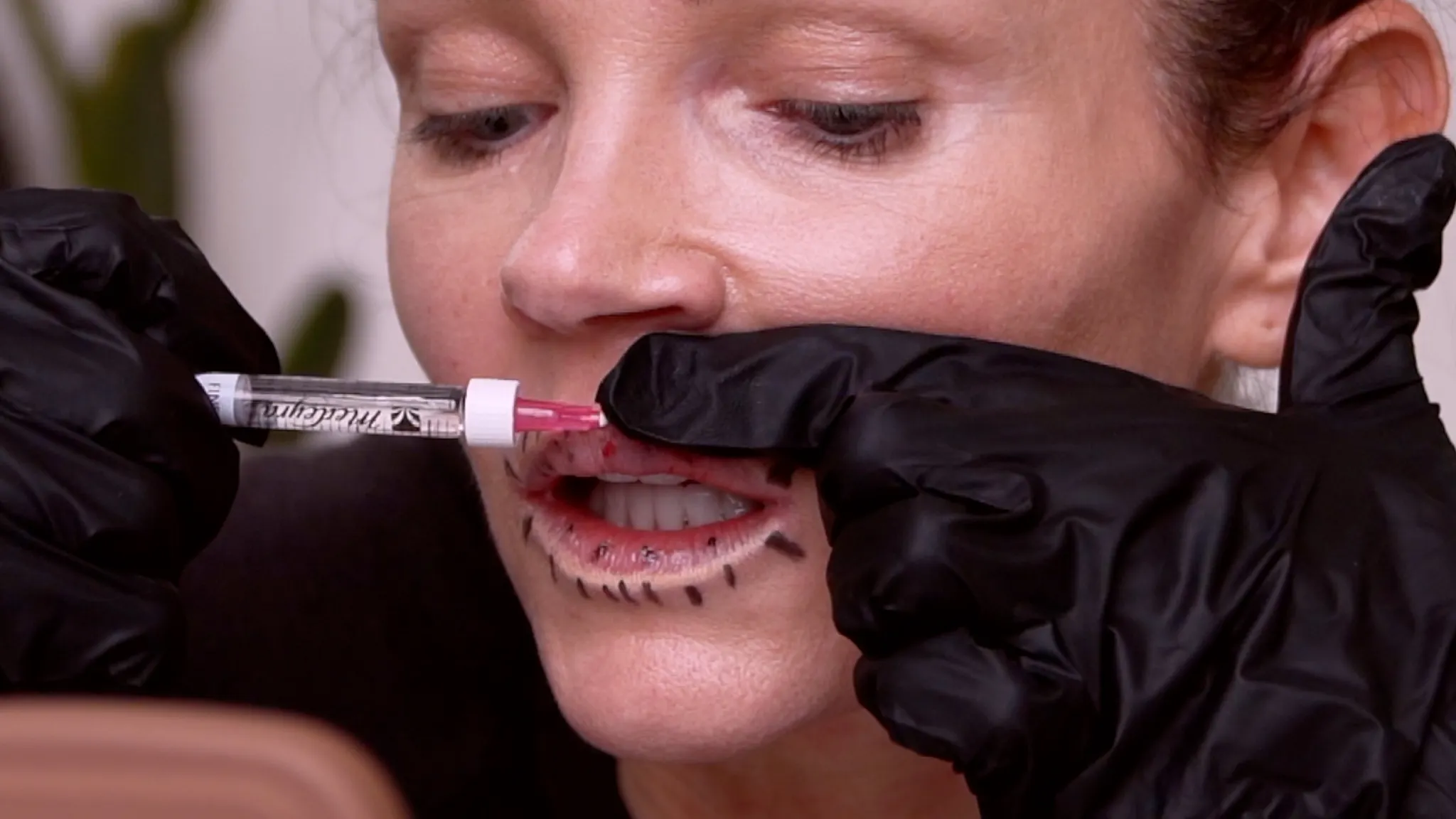 Russian Lip Filler Technique Explained: Why It Looks So Different - treatment image