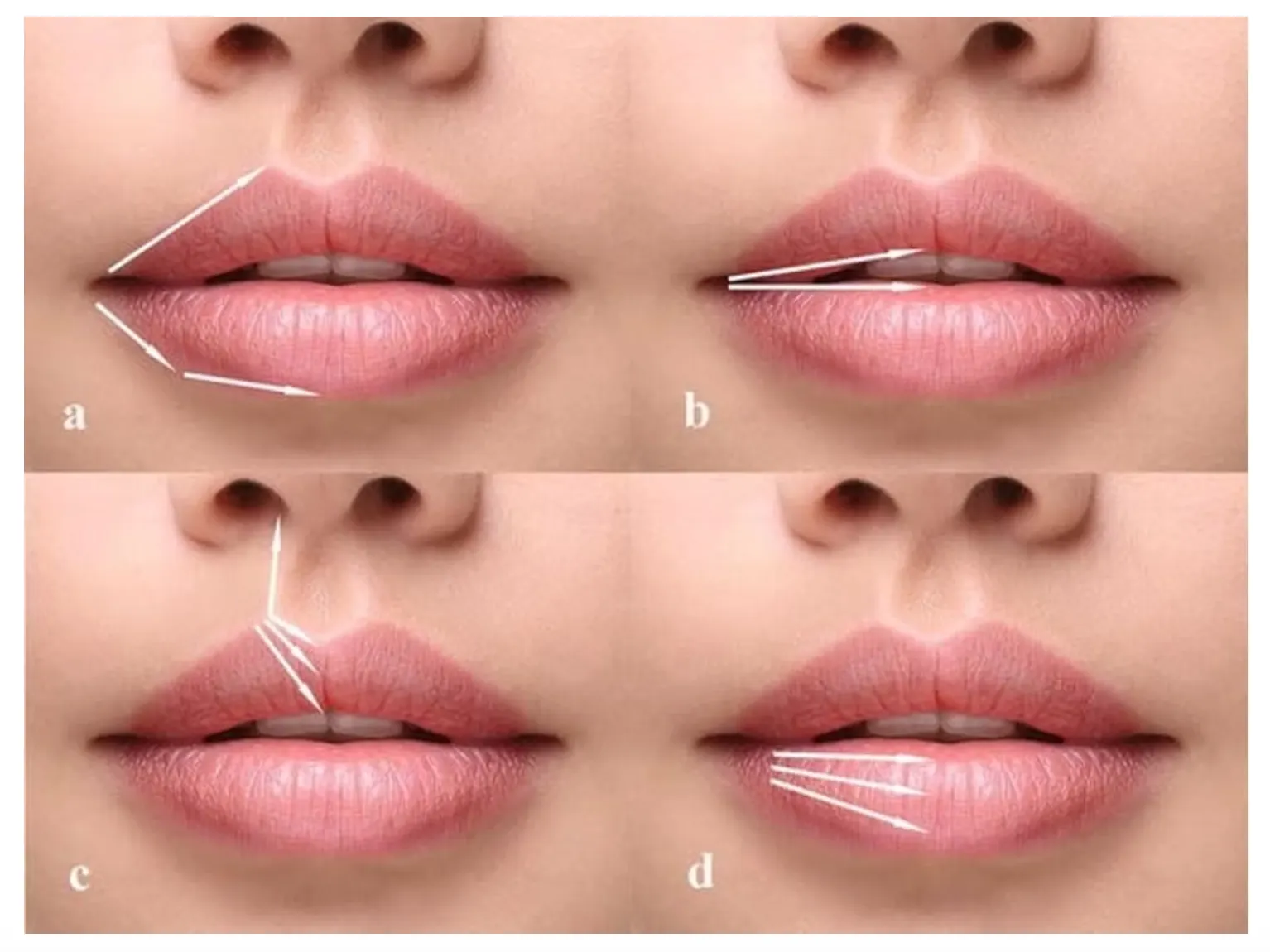 Russian Lip Filler Technique Explained: Why It Looks So Different - treatment image
