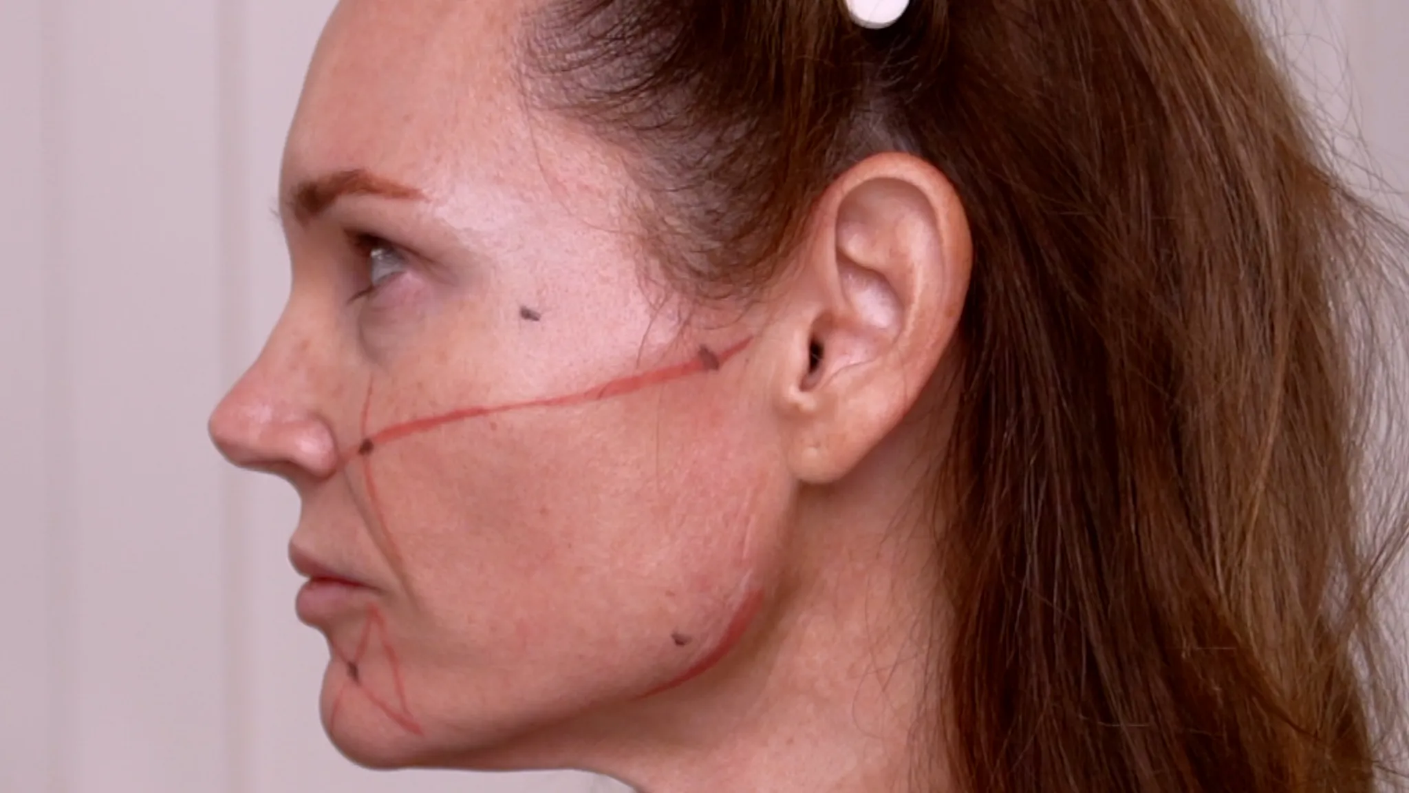 Rev’s Pro vs Profhilo vs Gouri | 2026 Biostimulator Comparison Guide - treatment image