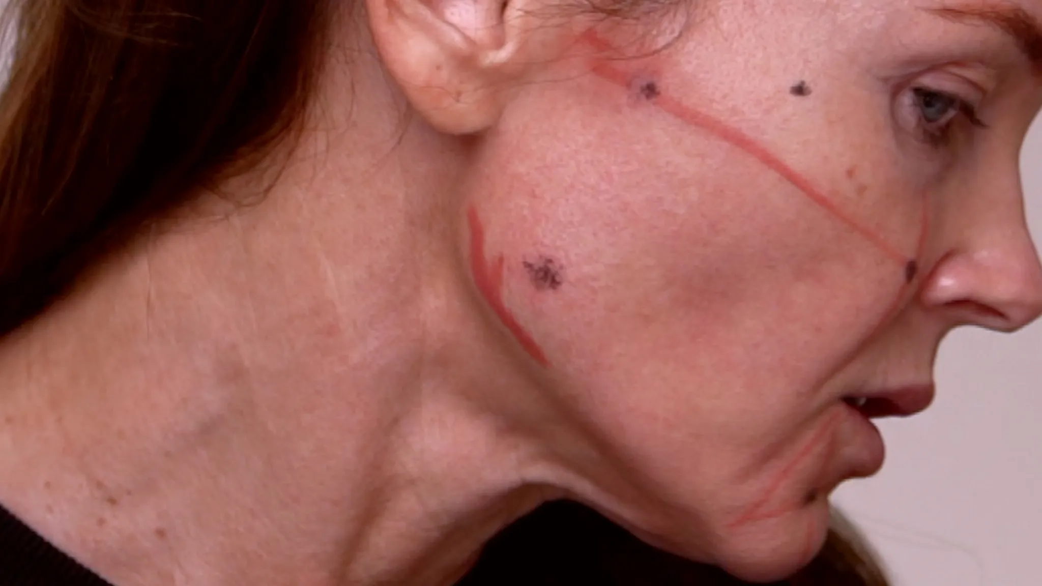 Rev’s Pro vs Profhilo vs Gouri | 2026 Biostimulator Comparison Guide - treatment image