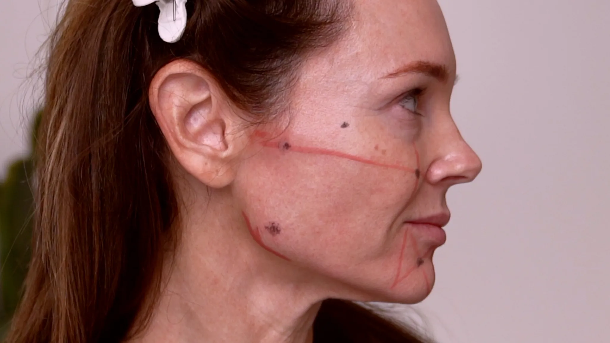 Rev’s Pro vs Profhilo vs Gouri | 2026 Biostimulator Comparison Guide - treatment image