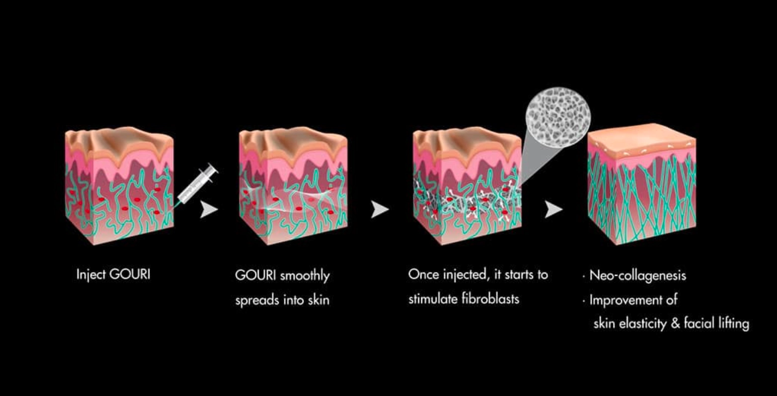 Rev’s Pro vs Profhilo vs Gouri | 2026 Biostimulator Comparison Guide - treatment image