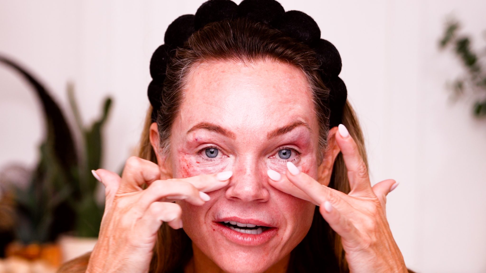 Curenex Eye + PCL Mono Threads for Under Eye & Lip Rejuvenation - treatment image