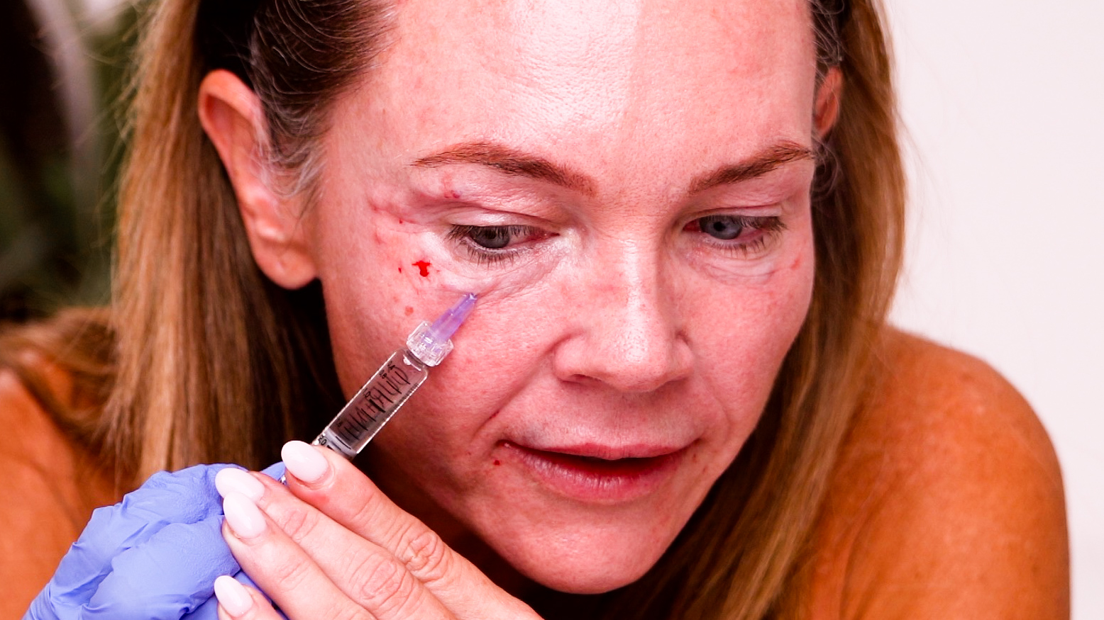 Curenex Eye + PCL Mono Threads for Under Eye & Lip Rejuvenation - treatment image