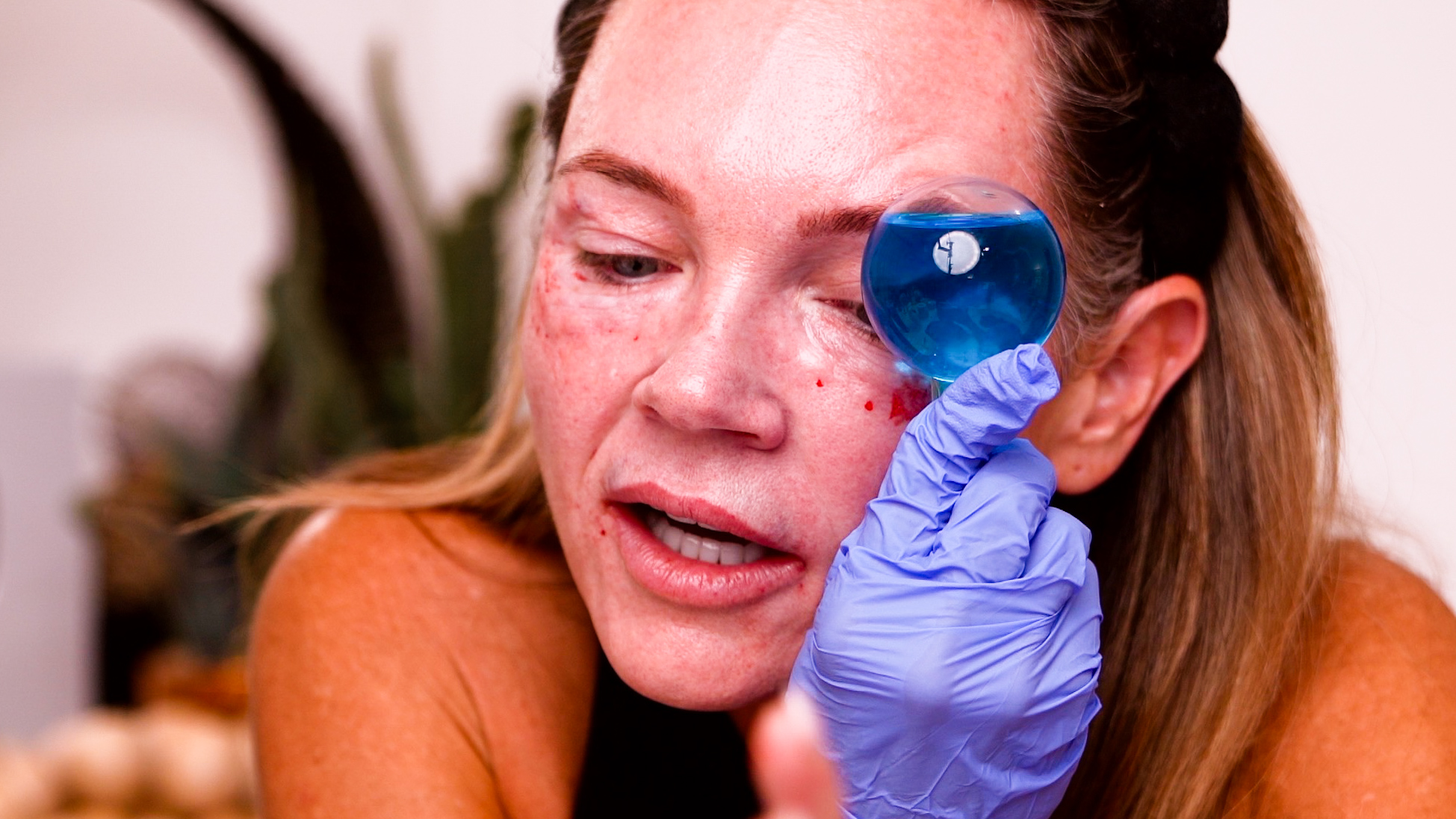 Curenex Eye + PCL Mono Threads for Under Eye & Lip Rejuvenation - treatment image