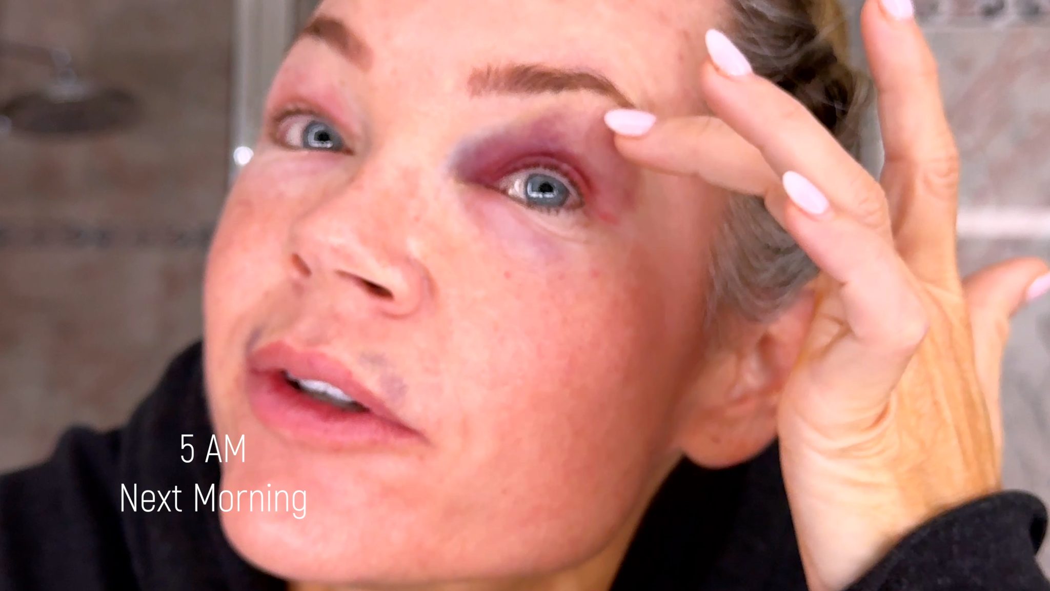 Curenex Eye + PCL Mono Threads for Under Eye & Lip Rejuvenation - treatment image