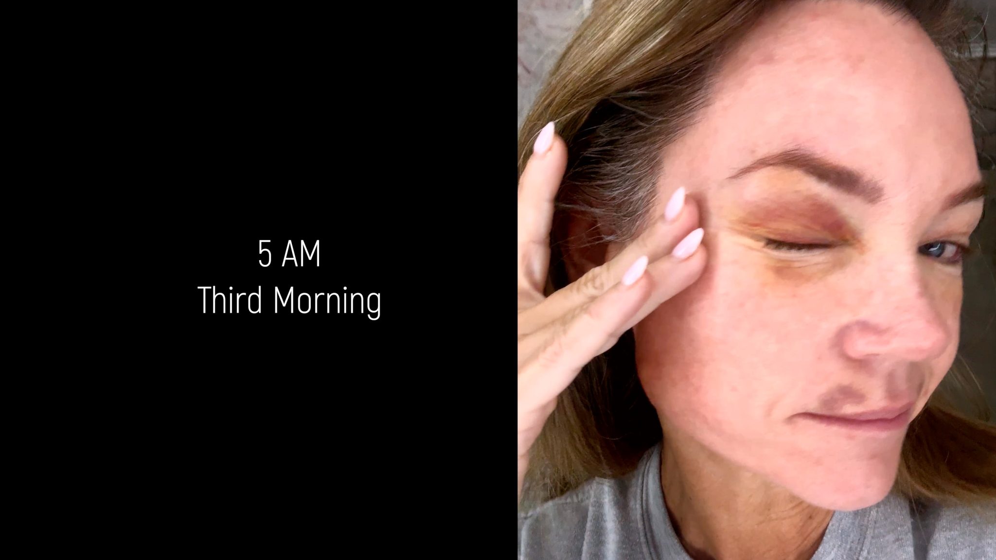 Curenex Eye + PCL Mono Threads for Under Eye & Lip Rejuvenation - treatment image
