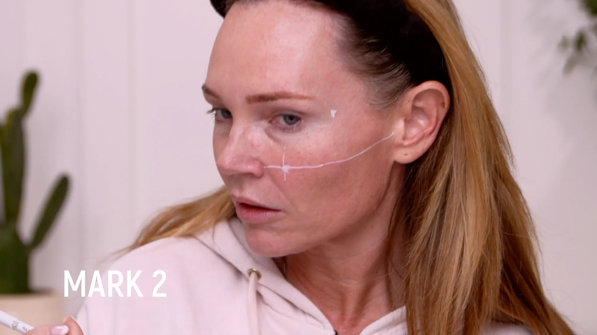 My Skin Quality and Neck Rejuvenation Plan With Revs Pro 32 + PCL Neck Threads - treatment image