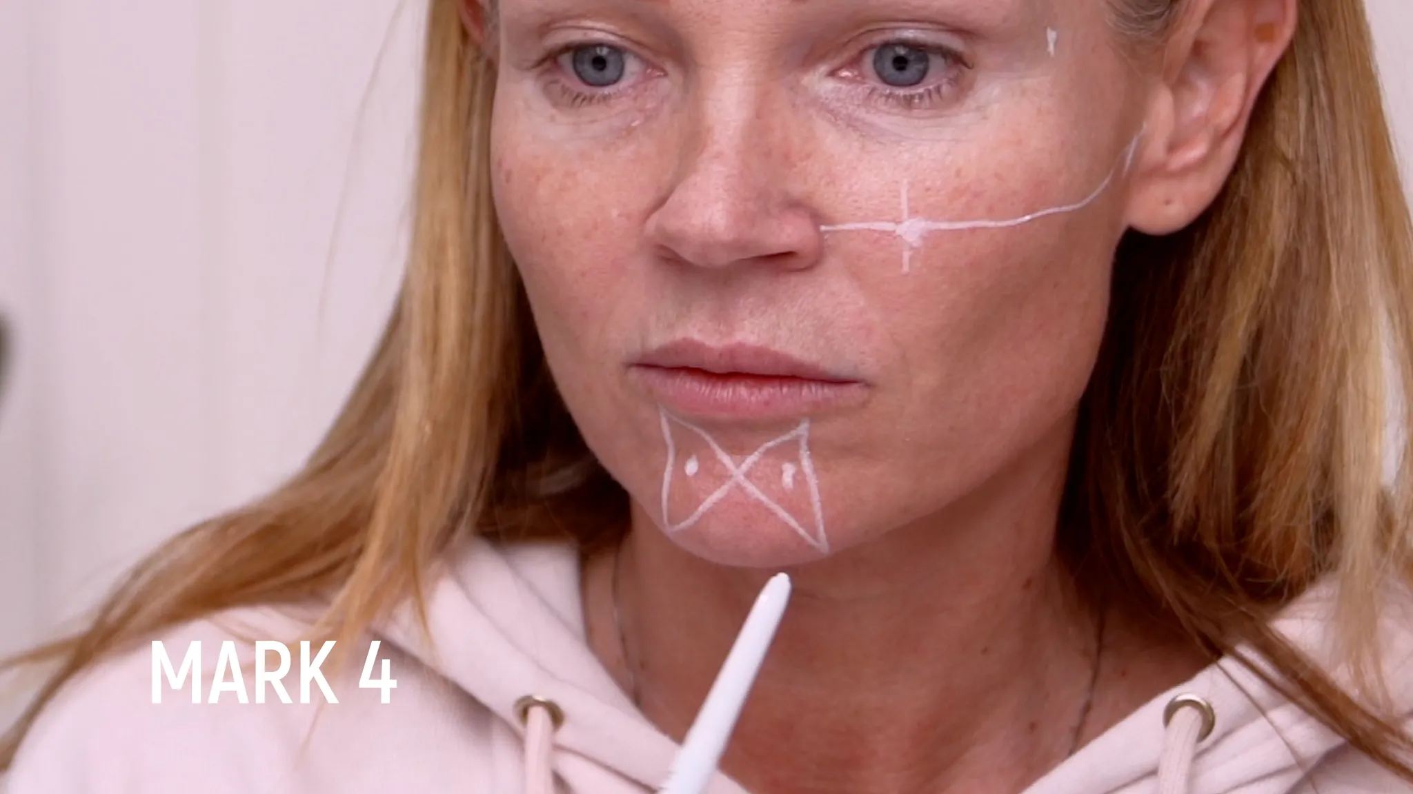 My Skin Quality and Neck Rejuvenation Plan With Revs Pro 32 + PCL Neck Threads - treatment image