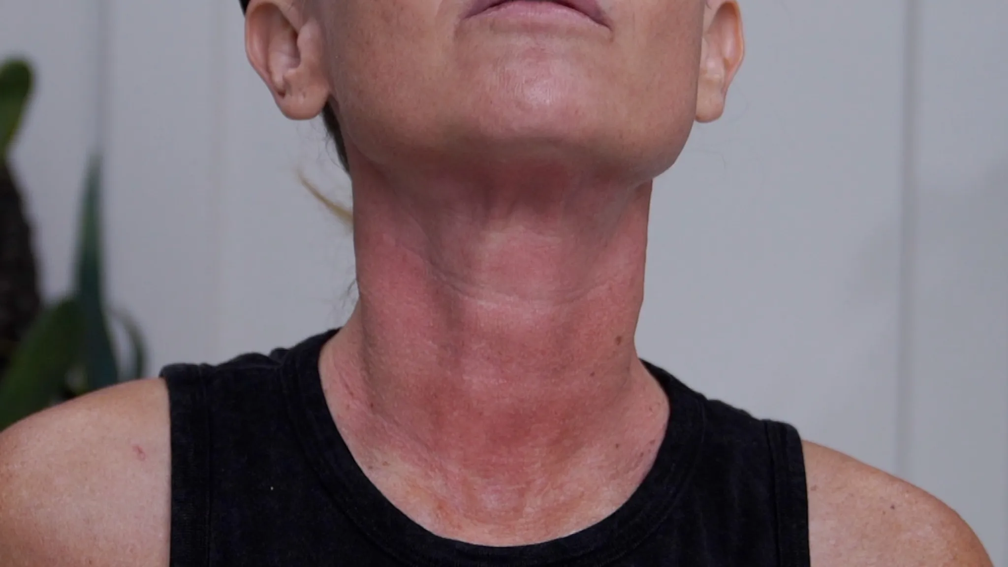 How I Microneedled My Neck at Home with the Dr. Pen M9 My 24-Hour Results - treatment image