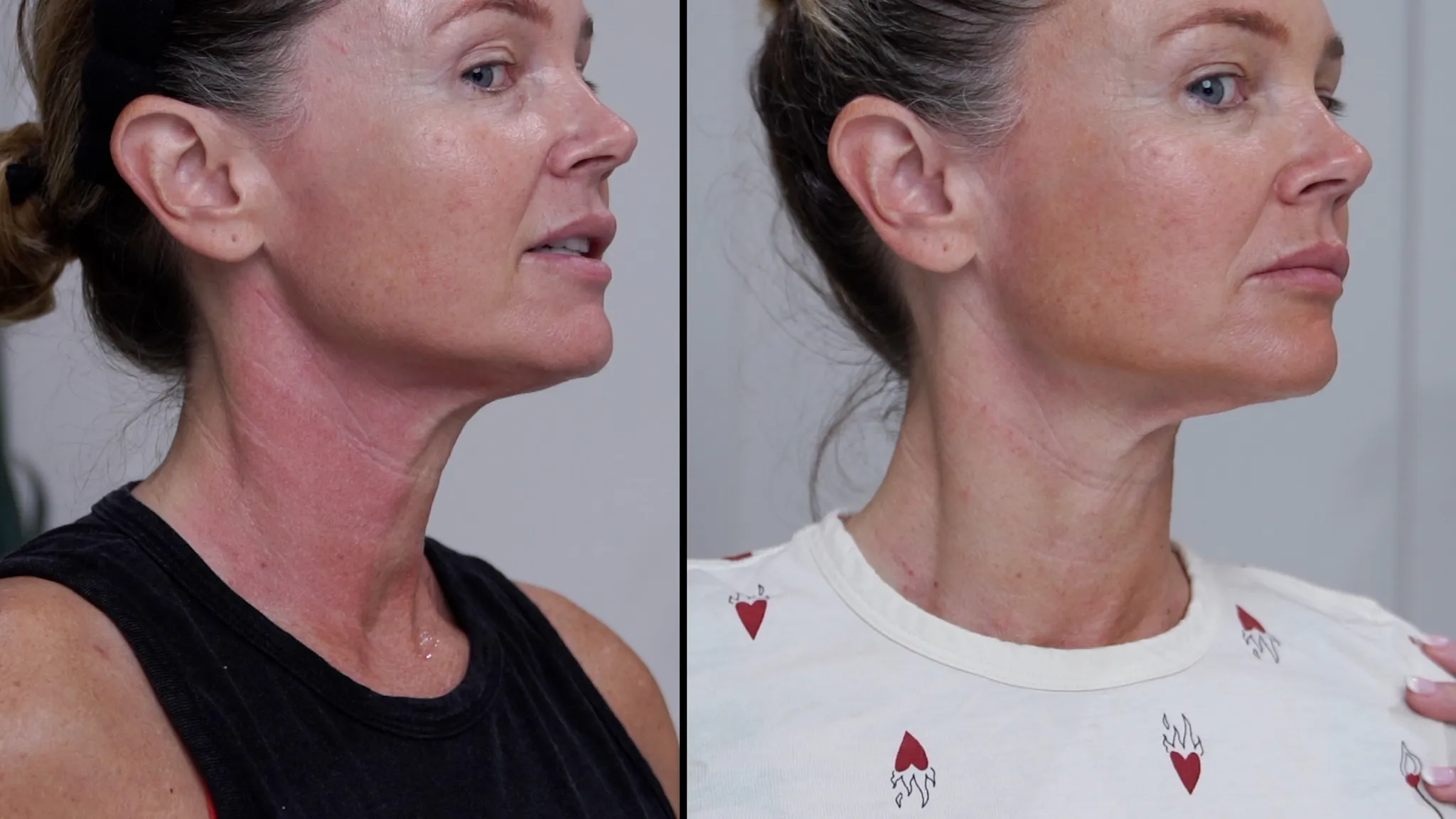 How I Microneedled My Neck at Home with the Dr. Pen M9 My 24-Hour Results - treatment image