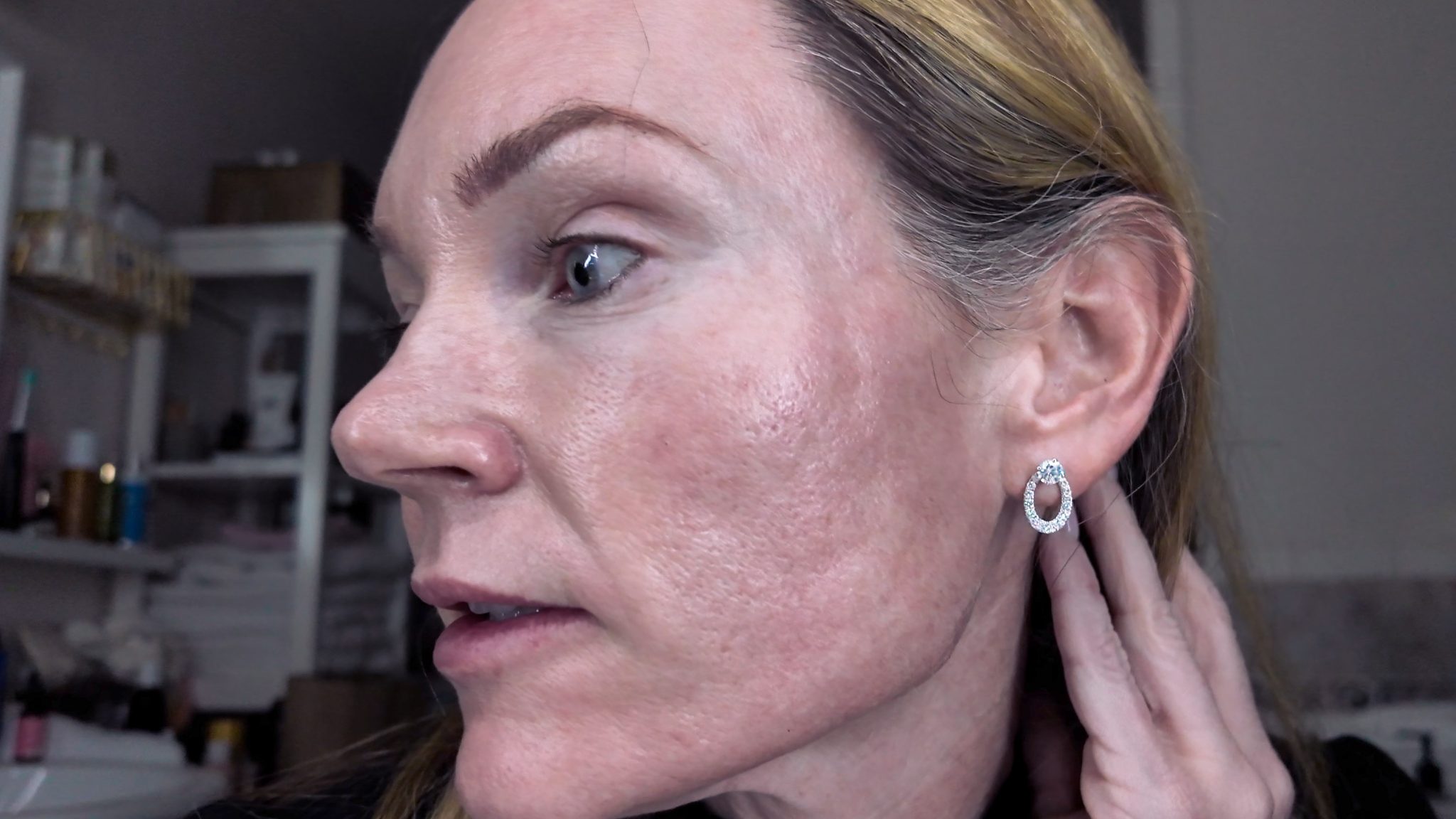 VBEAM LASER BEFORE AND AFTER - treatment image