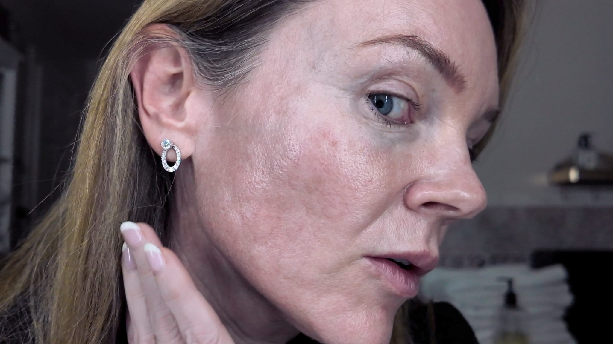 VBEAM LASER BEFORE AND AFTER - treatment image