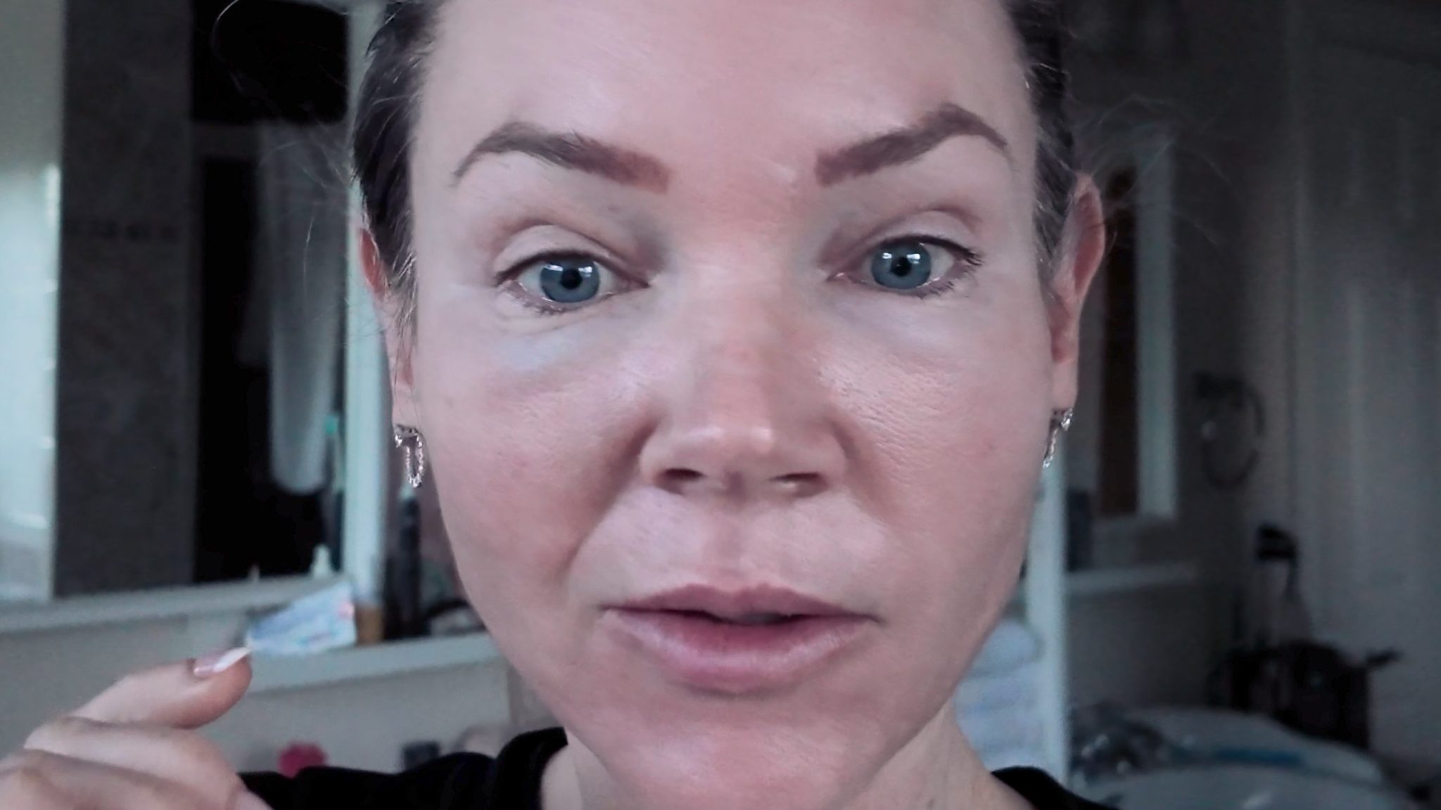 VBEAM LASER BEFORE AND AFTER - treatment image