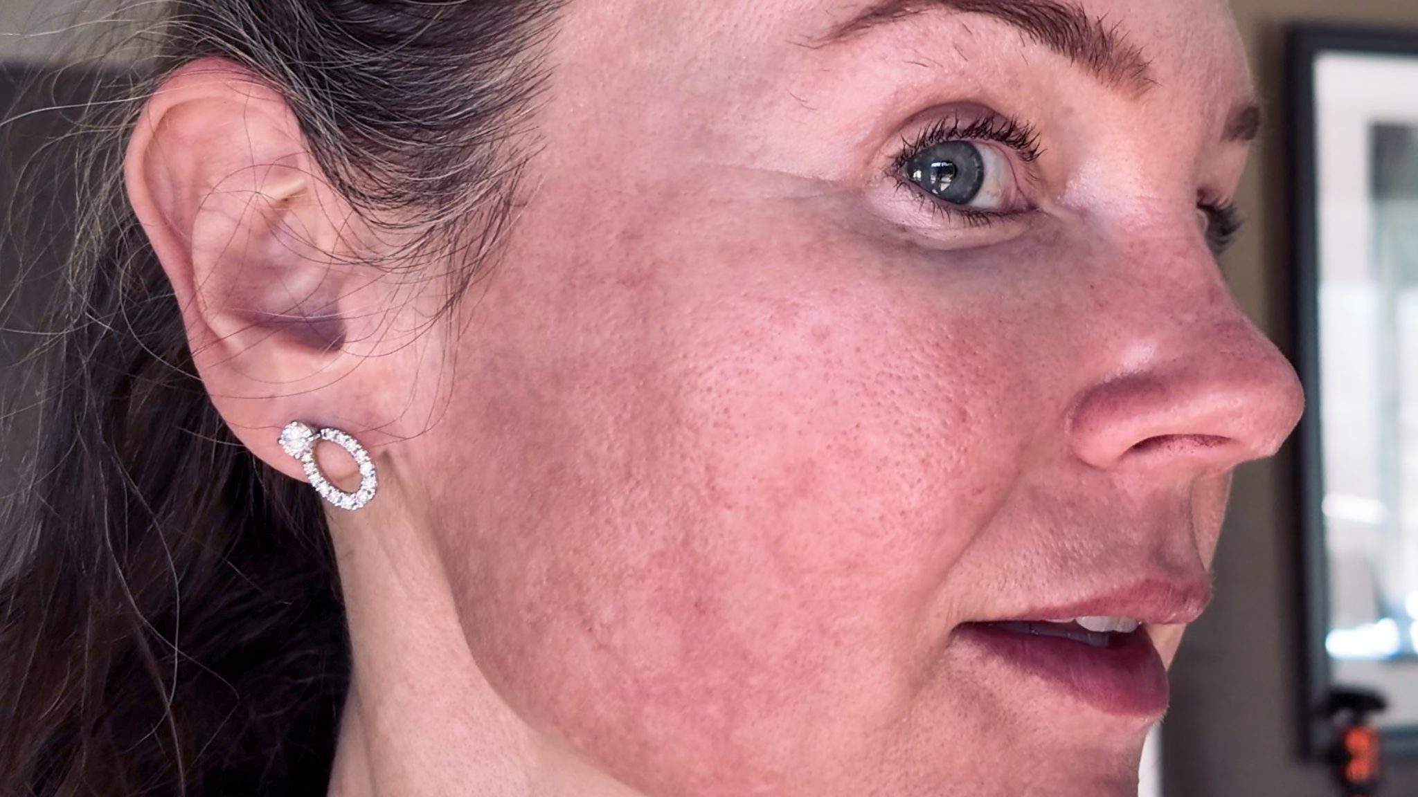 VBEAM LASER BEFORE AND AFTER - treatment image