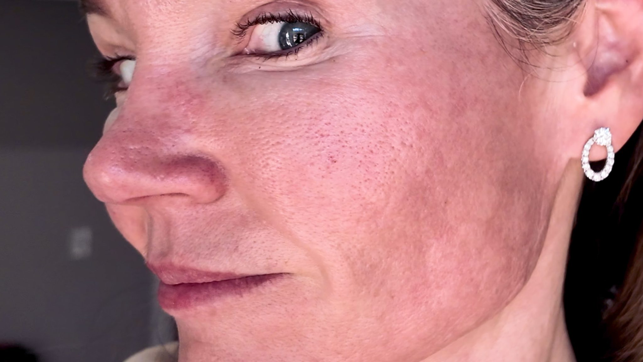VBEAM LASER BEFORE AND AFTER - treatment image