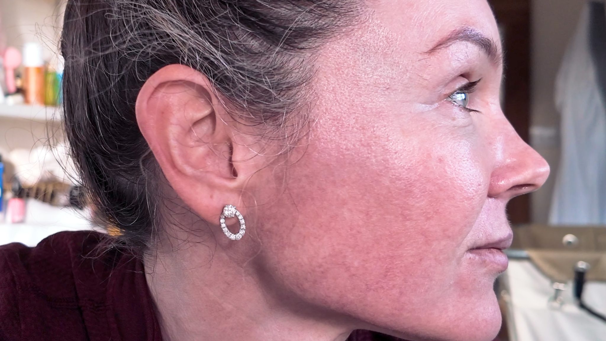 VBEAM LASER BEFORE AND AFTER - treatment image