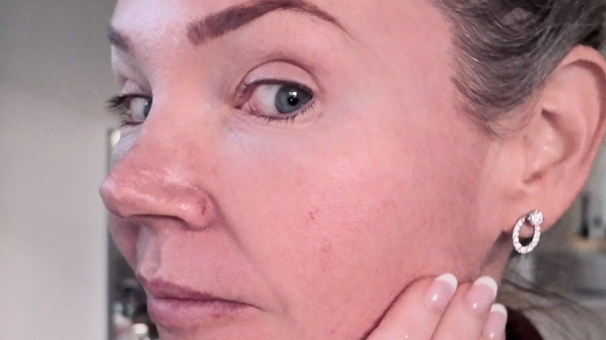 VBEAM LASER BEFORE AND AFTER - treatment image