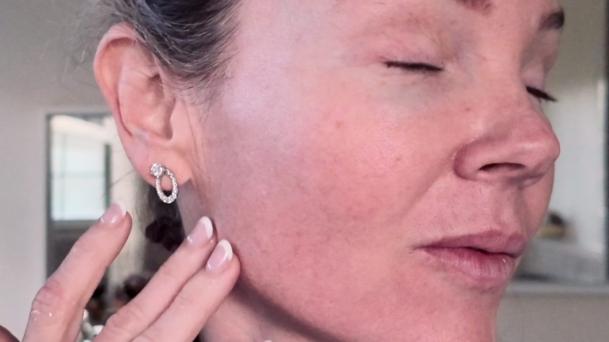 VBEAM LASER BEFORE AND AFTER - treatment image