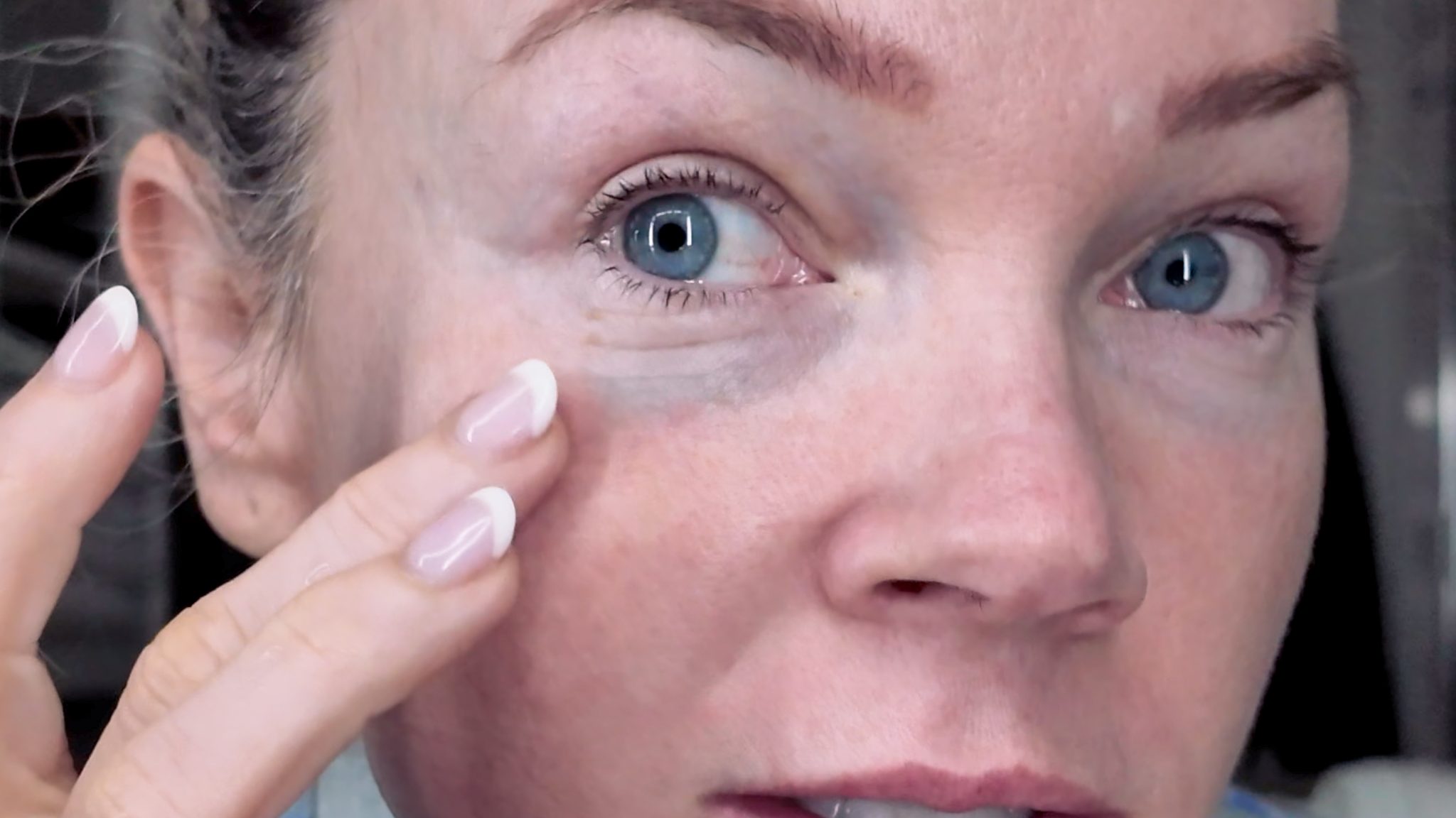 VBEAM LASER BEFORE AND AFTER - treatment image