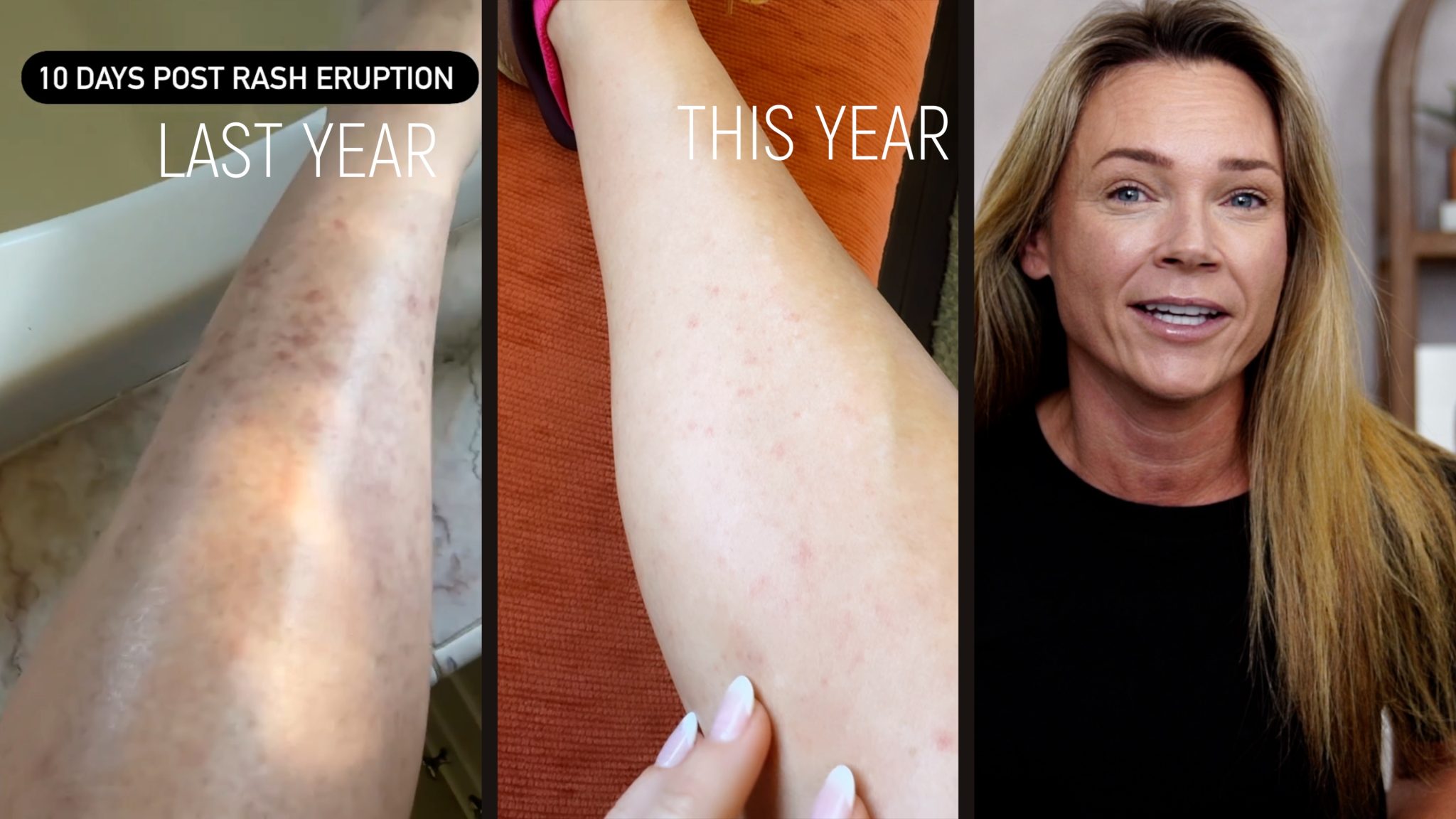 Using Melanotan to Prevent Polymorphous Light Eruption aka SUN POISONING - treatment image
