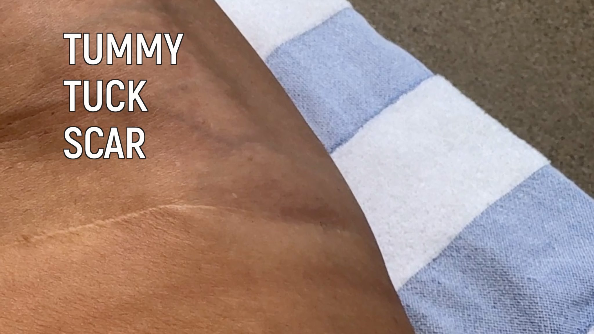 Get Your Glow On This Summer w/ Melanotan Tanning Peptides - treatment image