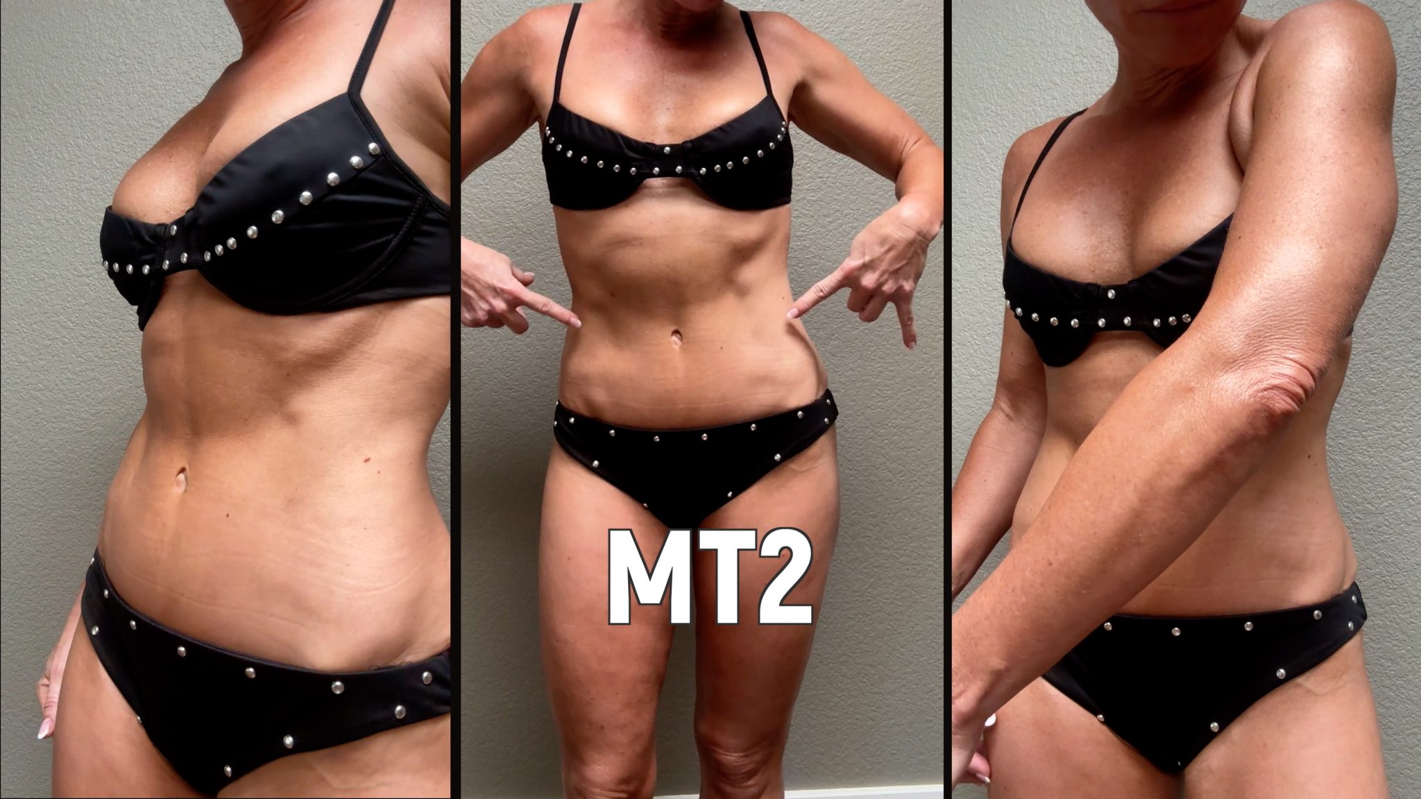 Melanotan 1 vs. 2: My Summer Journey & Real Results - treatment image