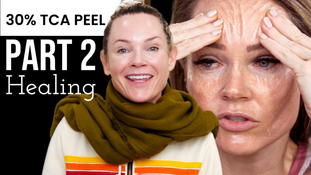 30% TCA PEEL PART 2 – HEALING