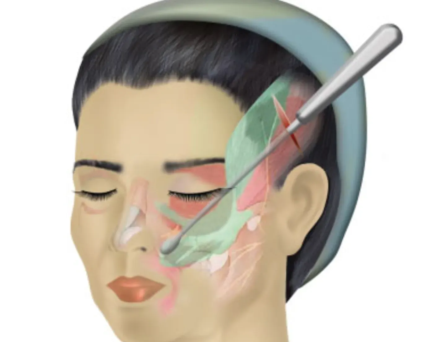 Do I Need a Facelift? Join Me for My Consultation Experience & Cost! - treatment image