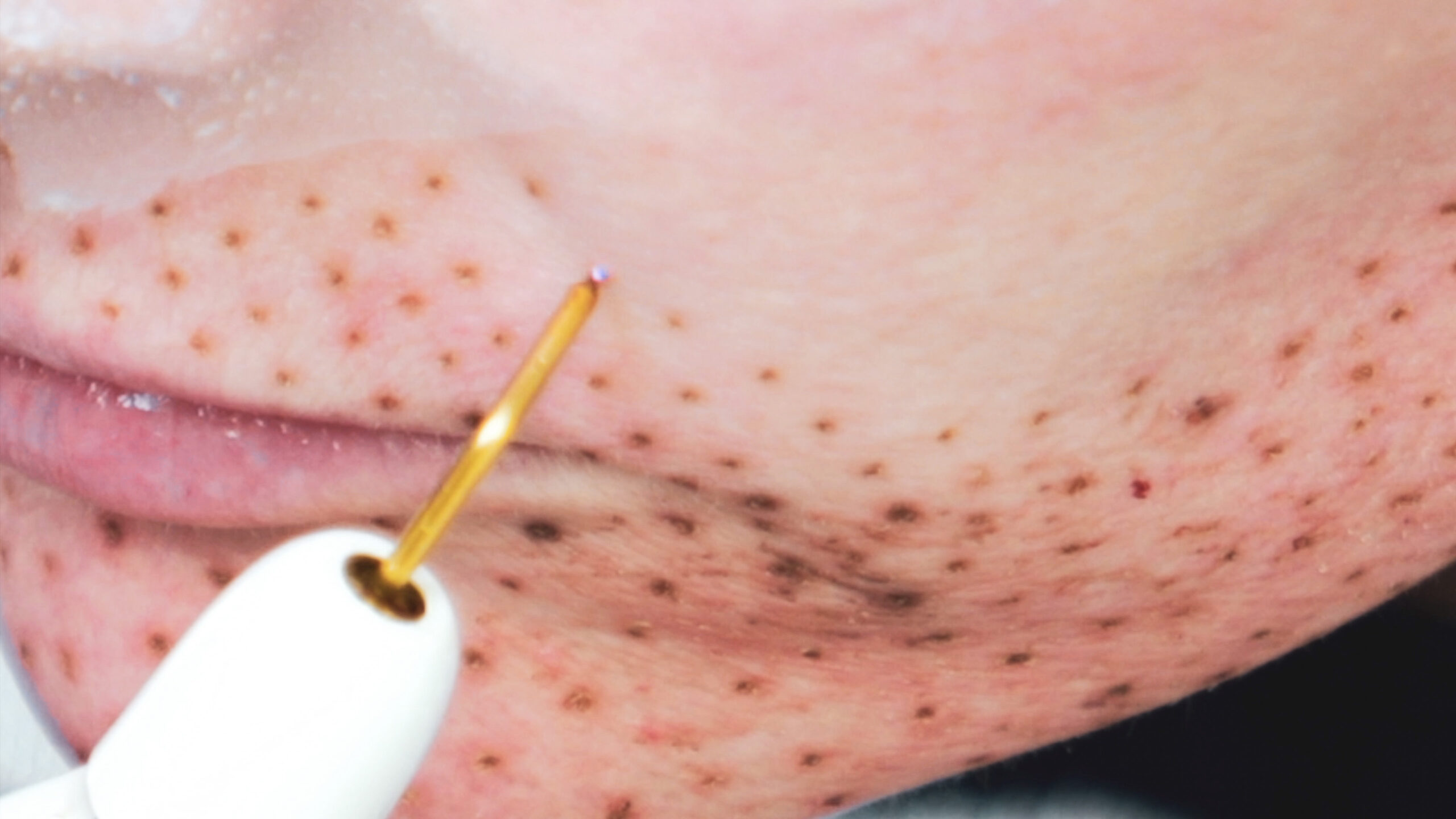 DIY PLASMA LIFT FIBROBLAST DEMO - treatment image