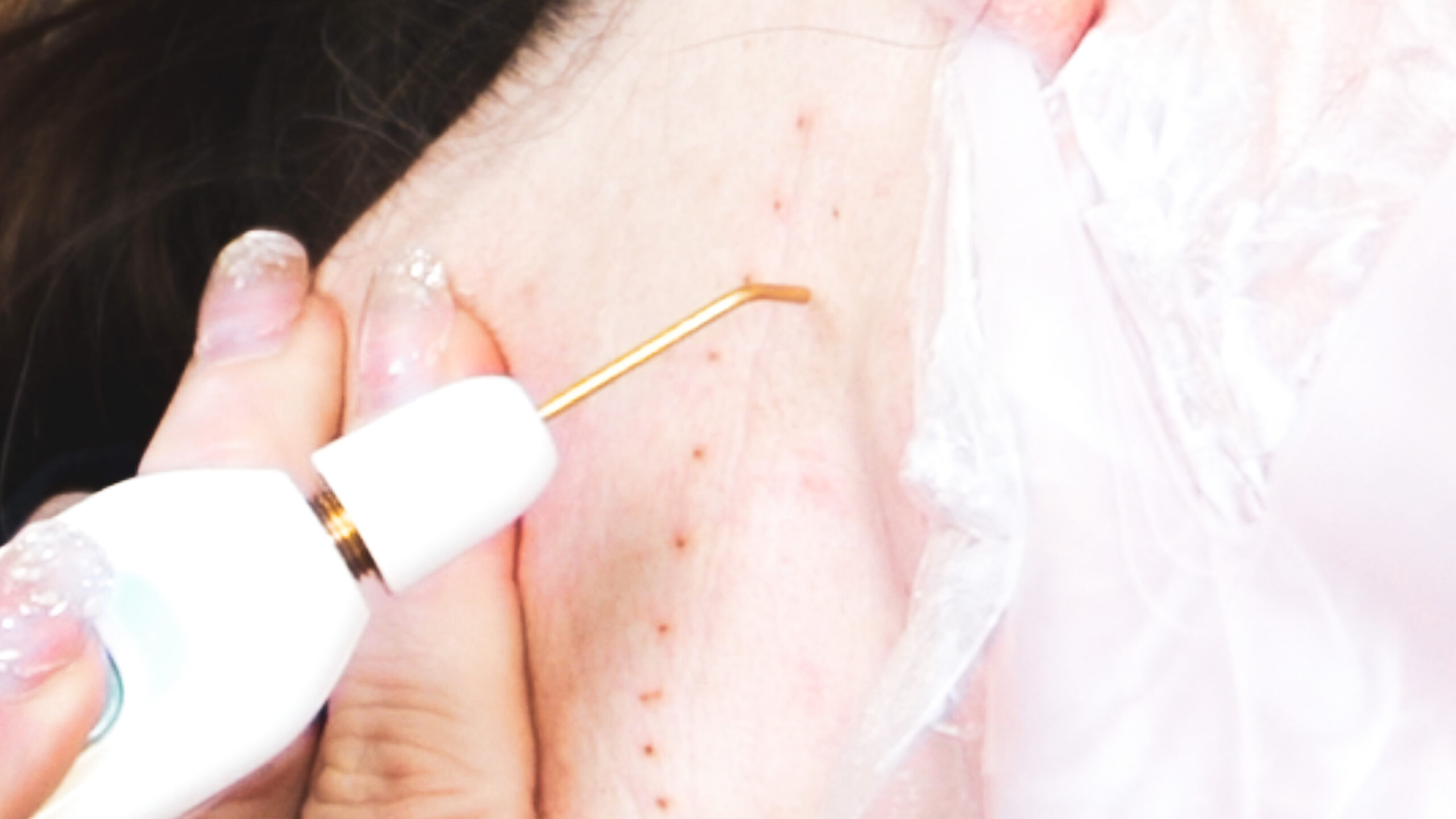 DIY PLASMA LIFT FIBROBLAST DEMO - treatment image