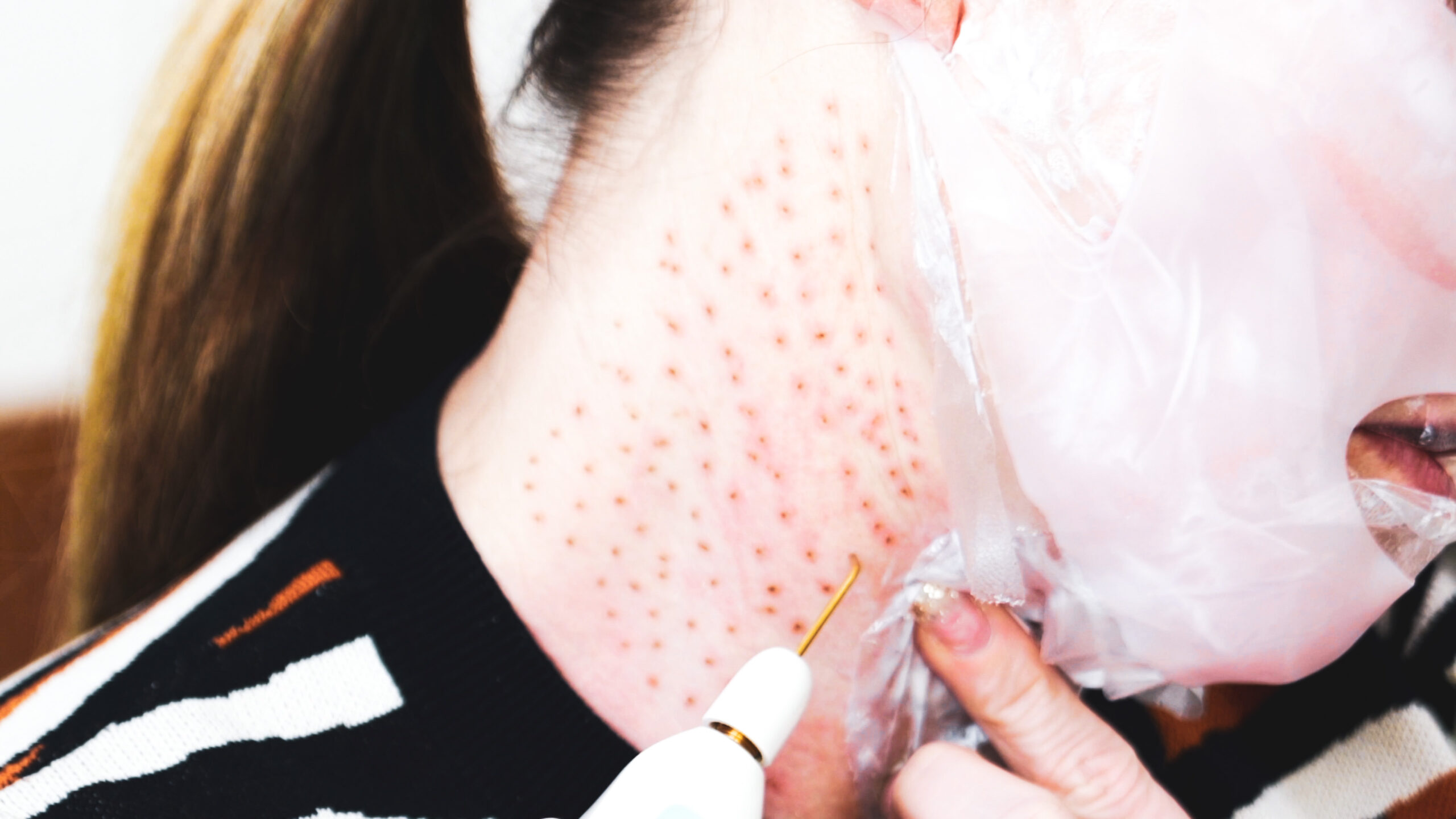 DIY PLASMA LIFT FIBROBLAST DEMO - treatment image