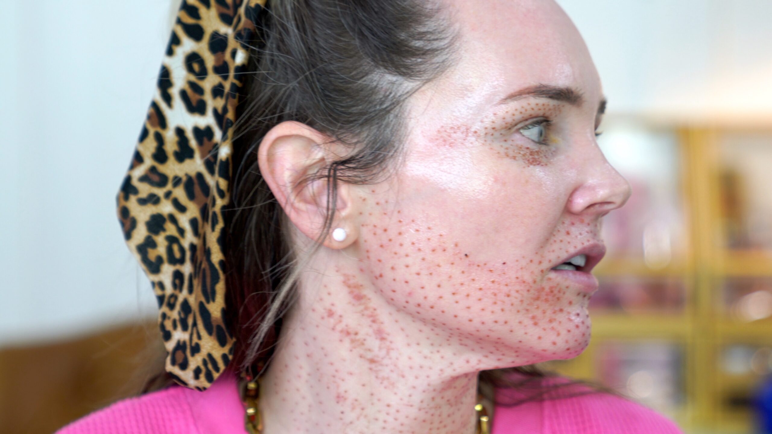 DIY PLASMA LIFT FIBROBLAST DEMO - treatment image