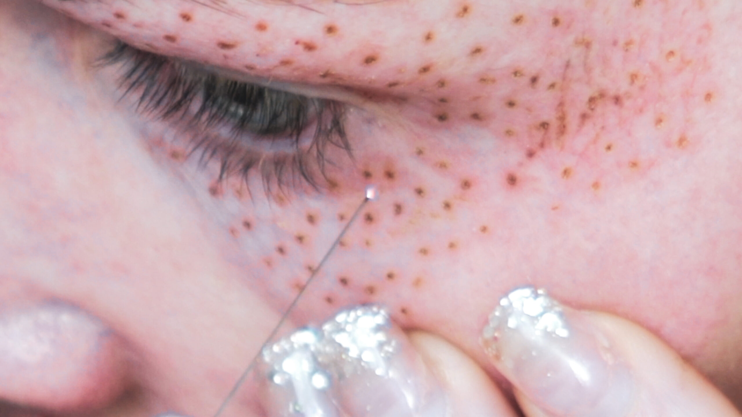DIY PLASMA LIFT FIBROBLAST DEMO - treatment image