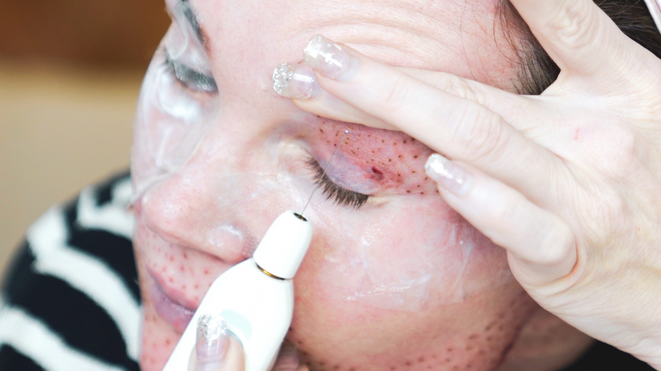 DIY PLASMA LIFT FIBROBLAST DEMO - treatment image