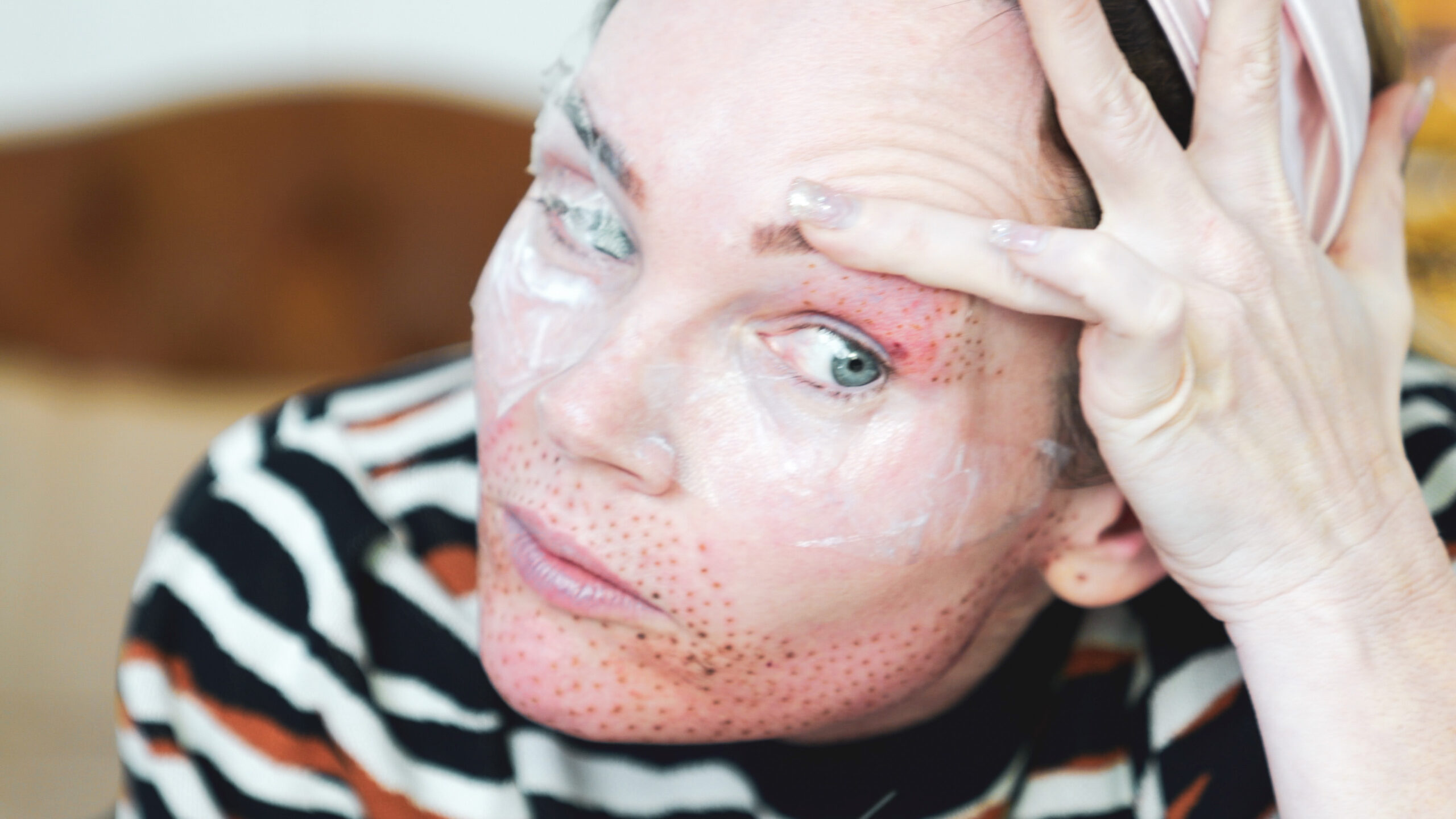 DIY PLASMA LIFT FIBROBLAST DEMO - treatment image