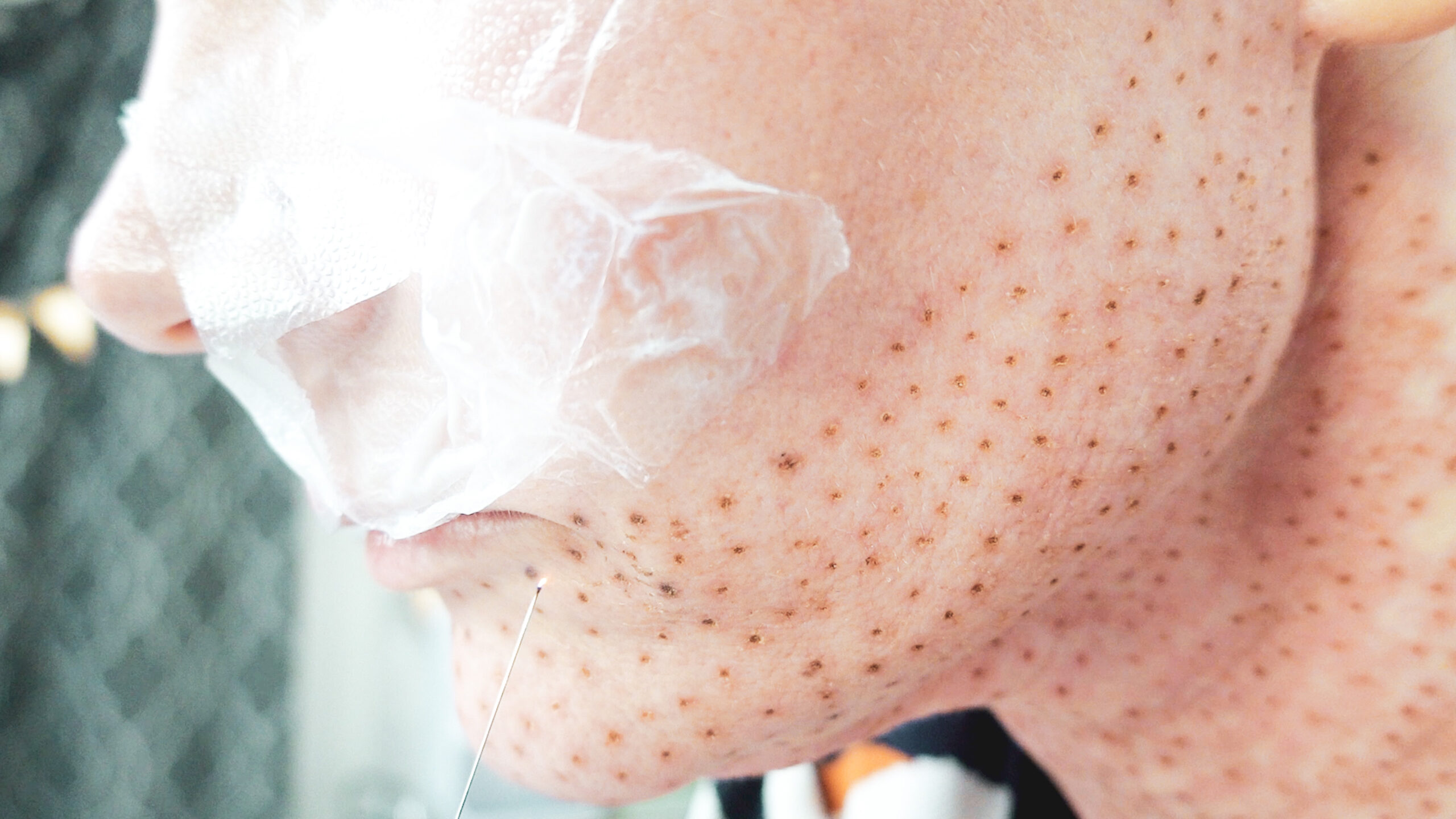 DIY PLASMA LIFT FIBROBLAST DEMO - treatment image