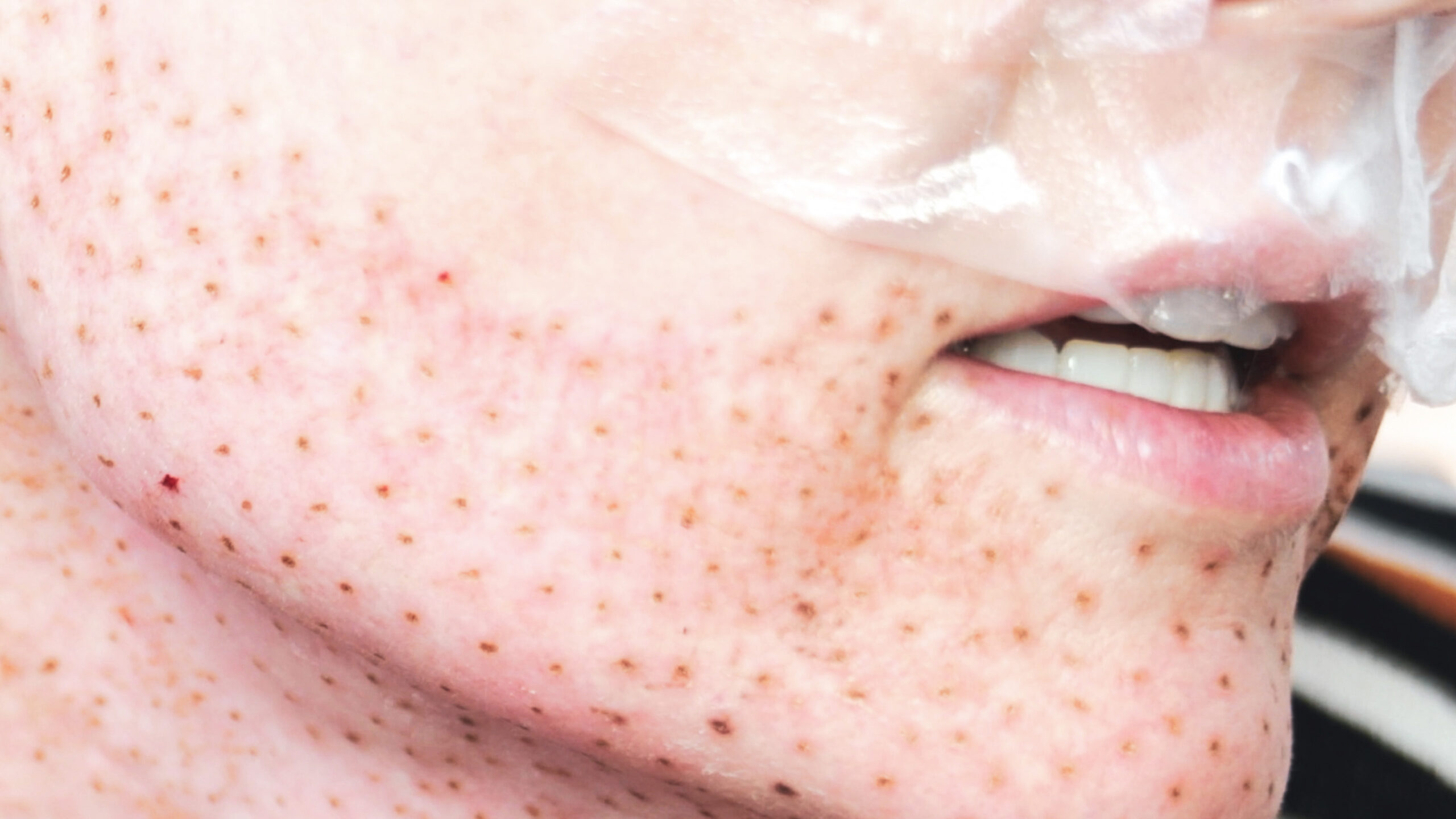 DIY PLASMA LIFT FIBROBLAST DEMO - treatment image