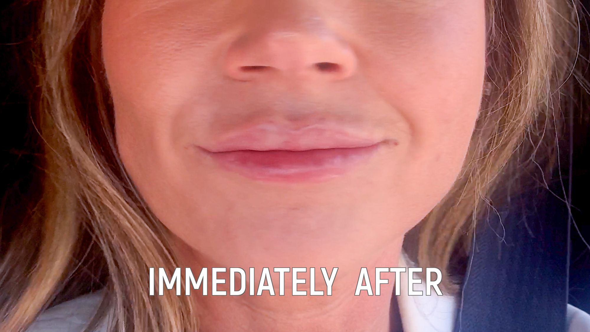 Restylane Kysse Lip Filler: Why the Cannula Method is a Game Changer! - treatment image