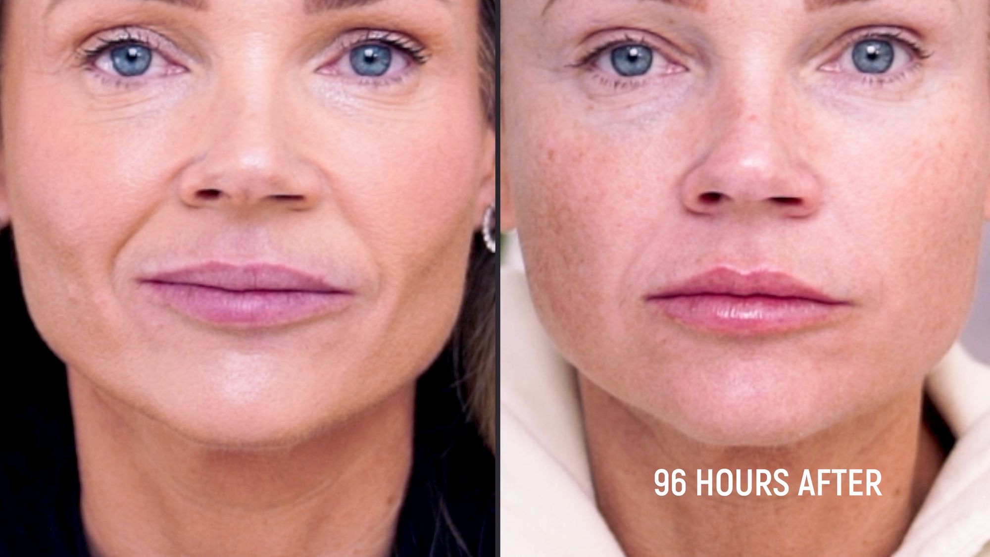 Restylane Kysse Lip Filler: Why the Cannula Method is a Game Changer! - treatment image