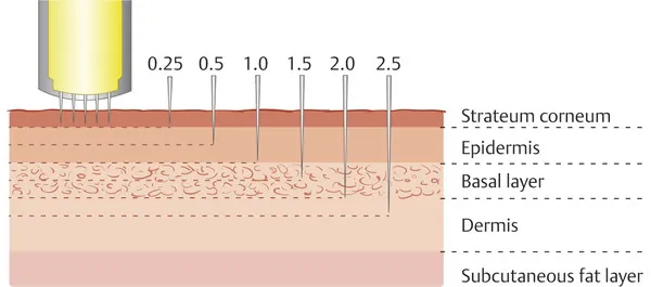 MICRONEEDLING 101 - treatment image