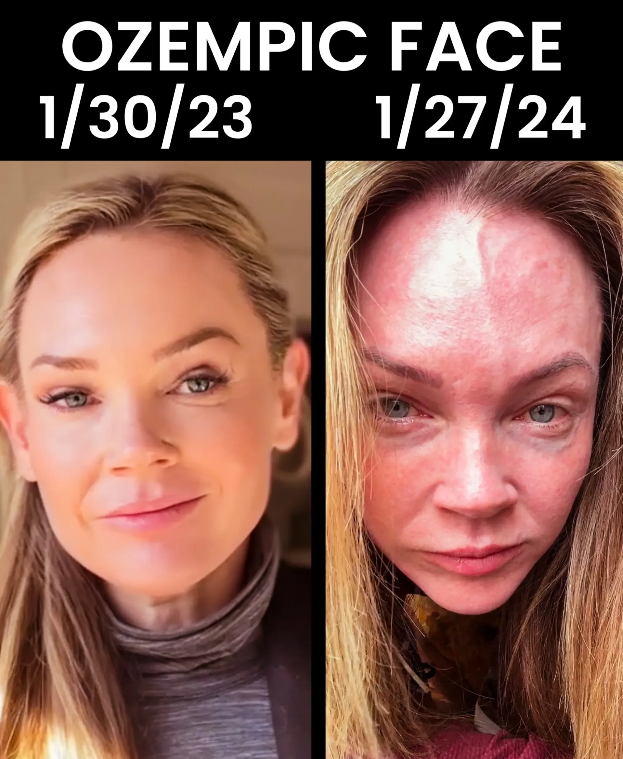 Biostimulators: How to Build Face Volume with Mayster PLLA & Gouri - treatment image