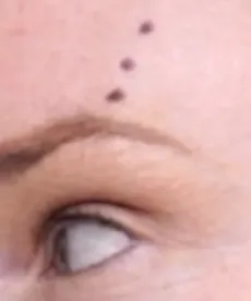 Biostimulators: How to Build Face Volume with Mayster PLLA & Gouri - treatment image