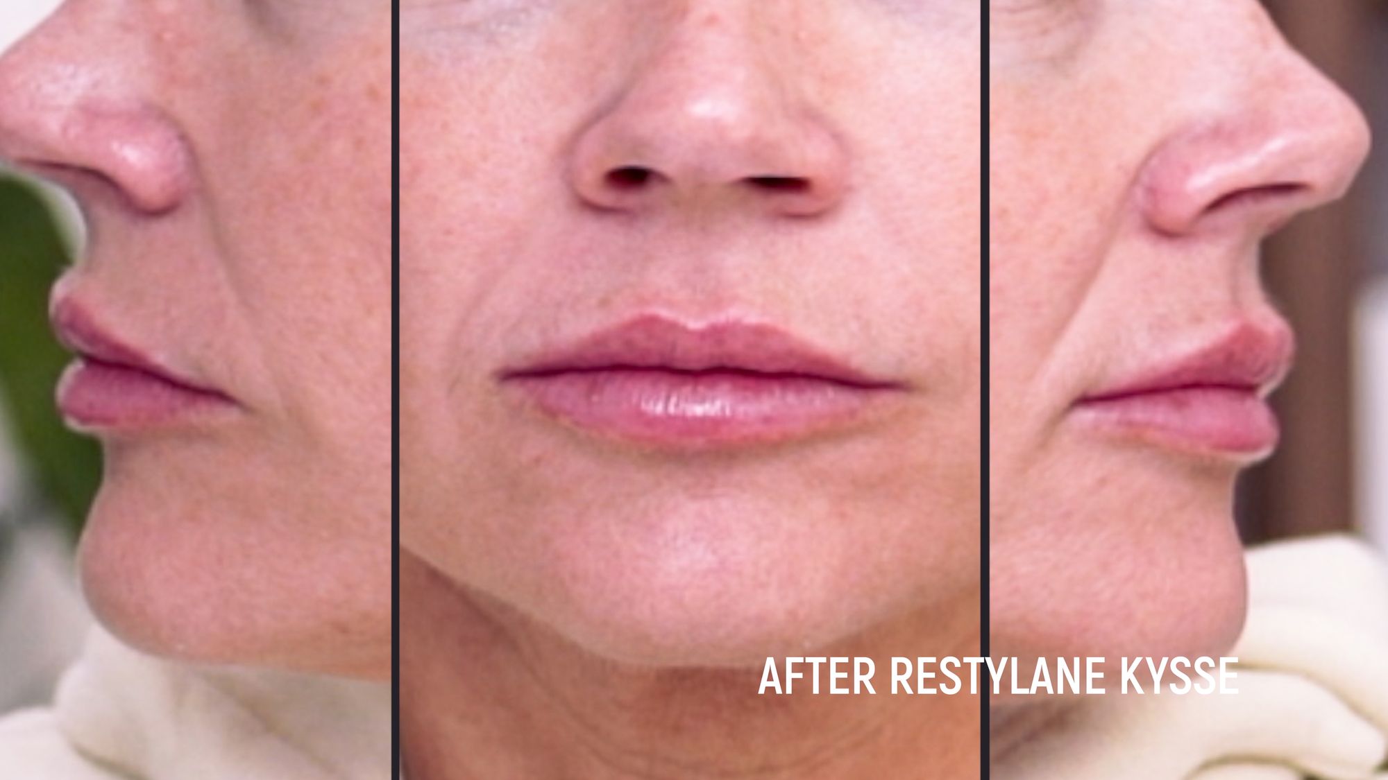 Restylane Kysse Lip Filler: Why the Cannula Method is a Game Changer! - treatment image
