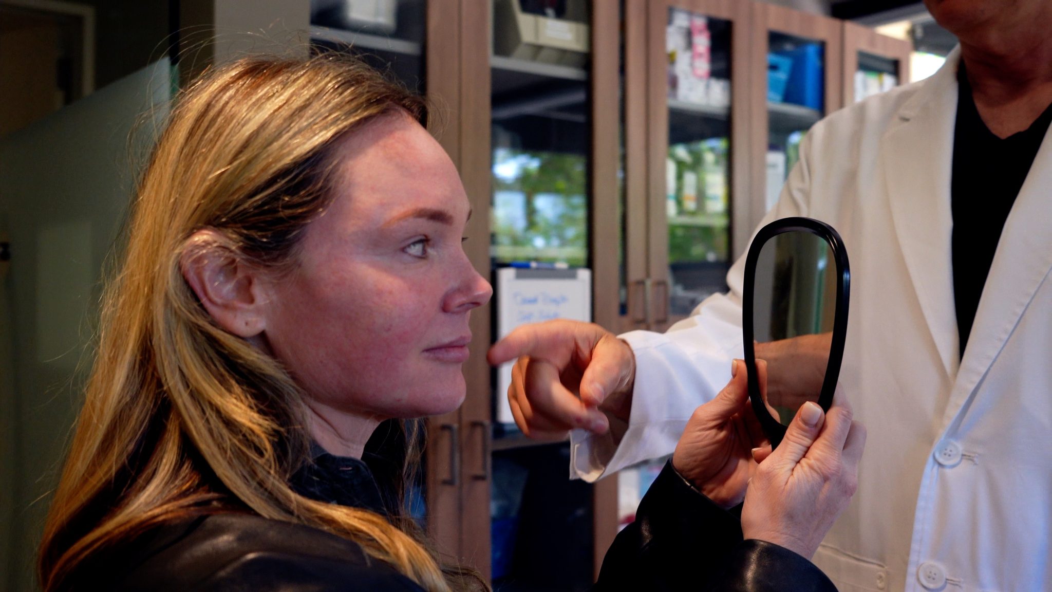 SCULPTRA 1 YEAR AFTER 4 VIALS COMPARISON - treatment image