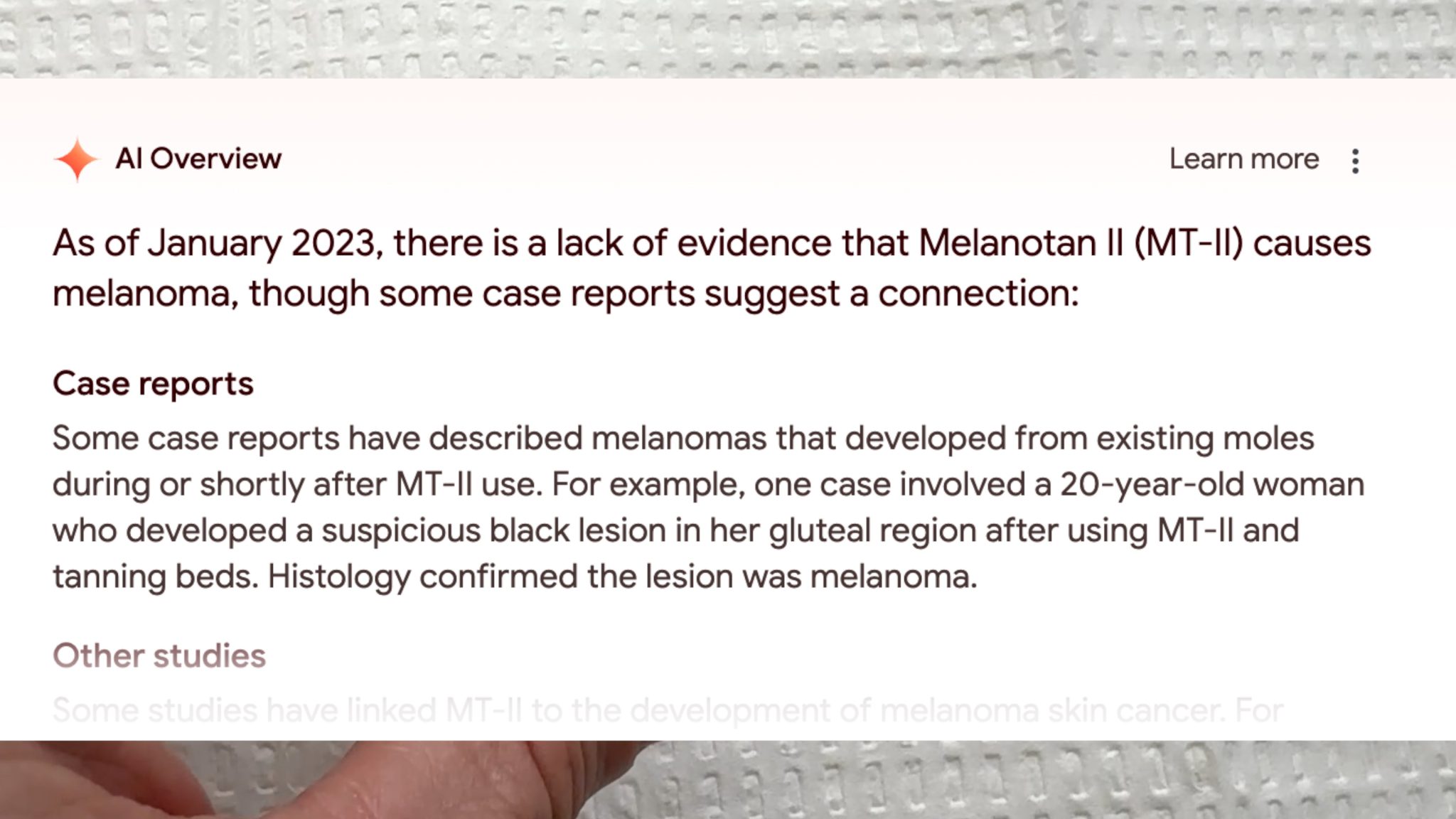 Using Melanotan to Prevent Polymorphous Light Eruption aka SUN POISONING - treatment image