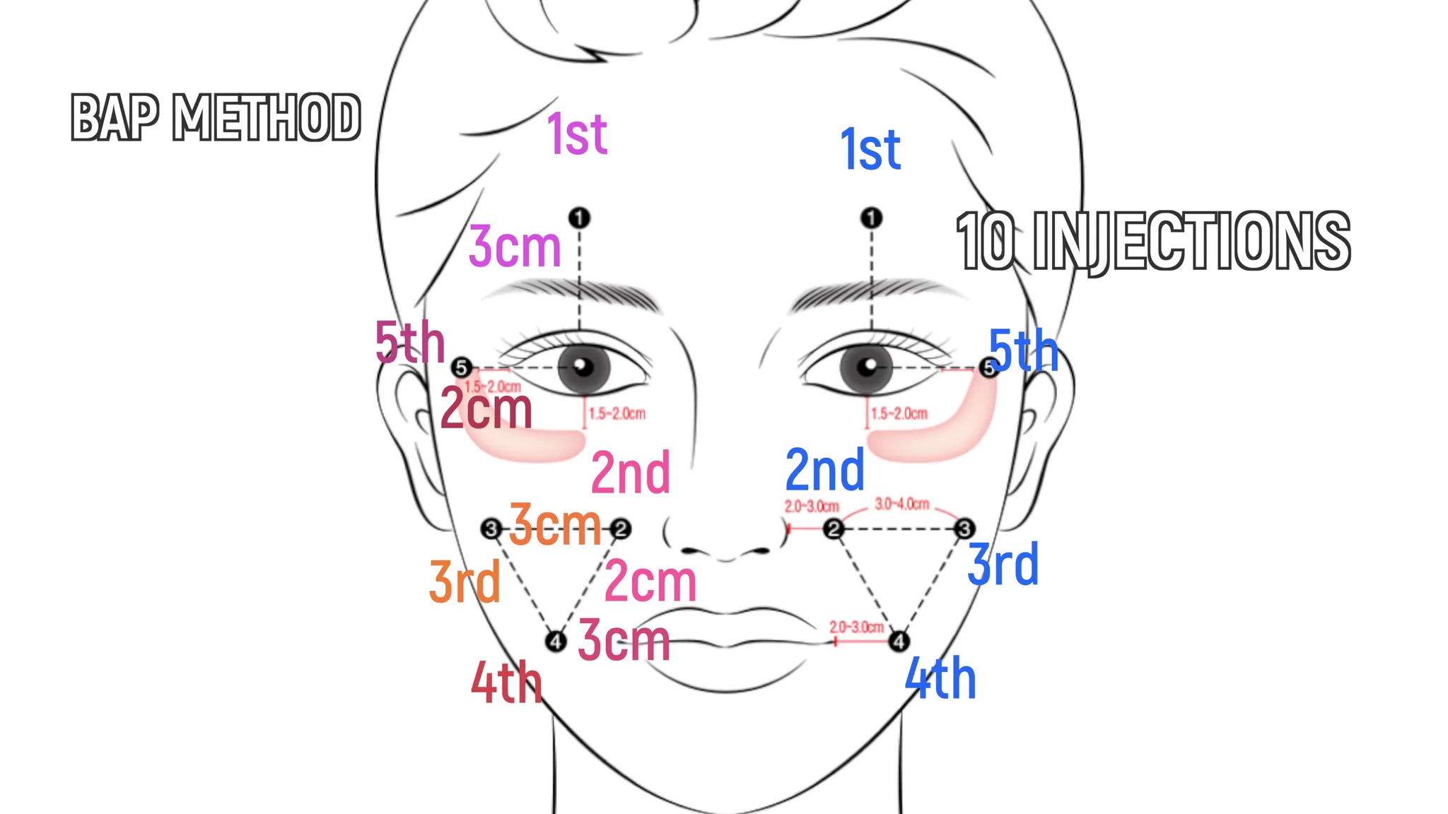 Biostimulators: How to Build Face Volume with Mayster PLLA & Gouri - treatment image