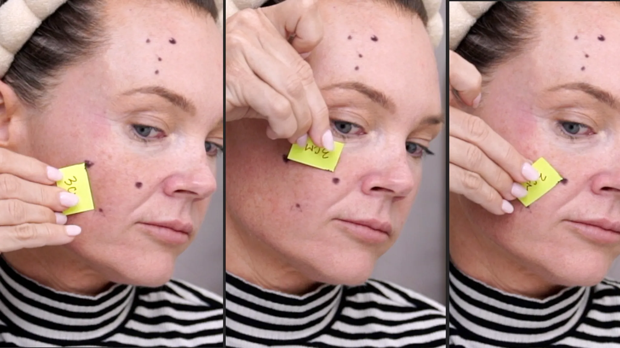 Biostimulators: How to Build Face Volume with Mayster PLLA & Gouri - treatment image