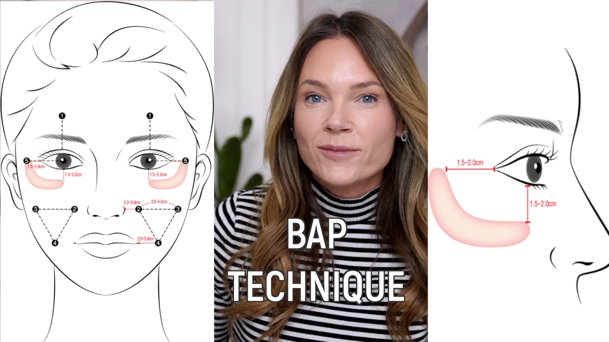Biostimulators: How to Build Face Volume with Mayster PLLA & Gouri - treatment image