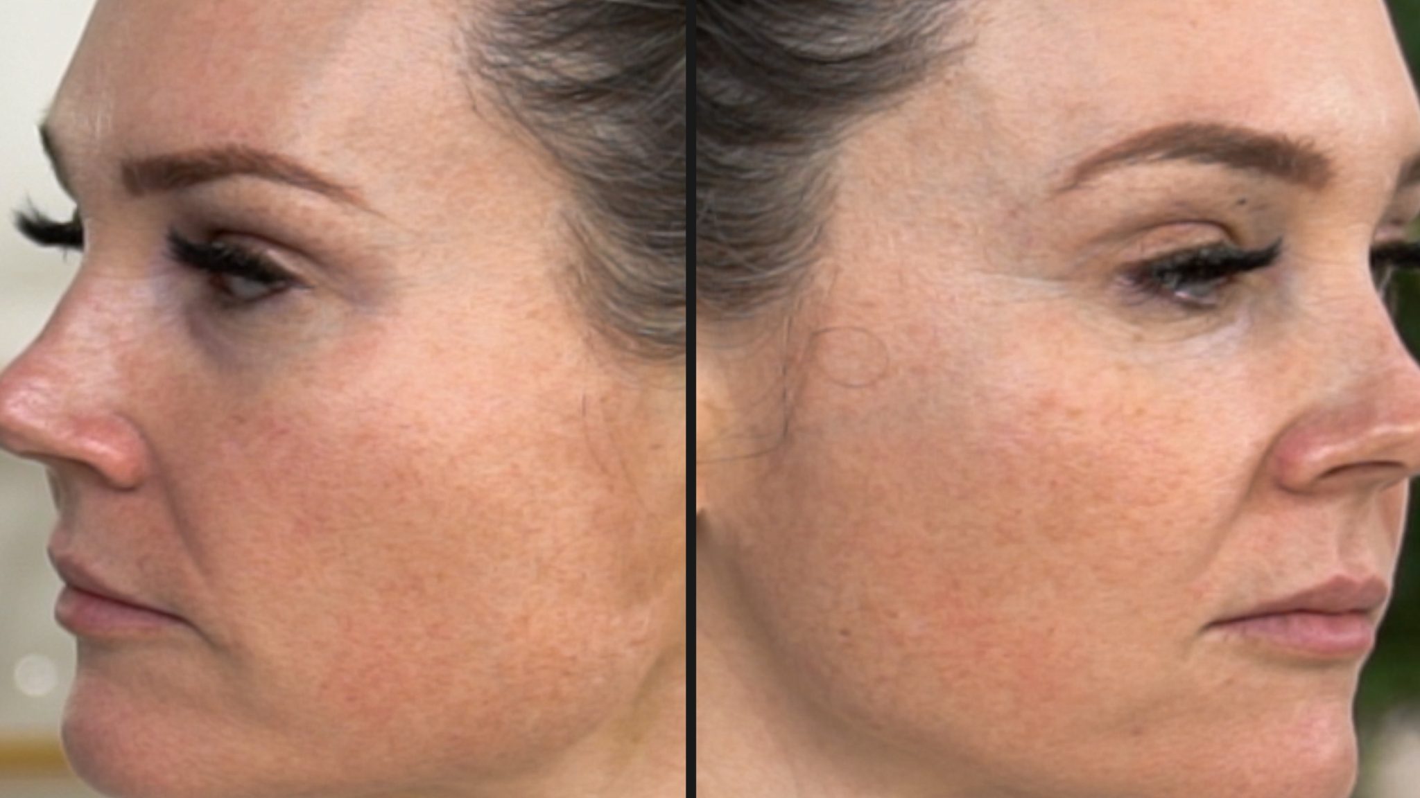 30% TCA PEEL PART 2 – HEALING - treatment image
